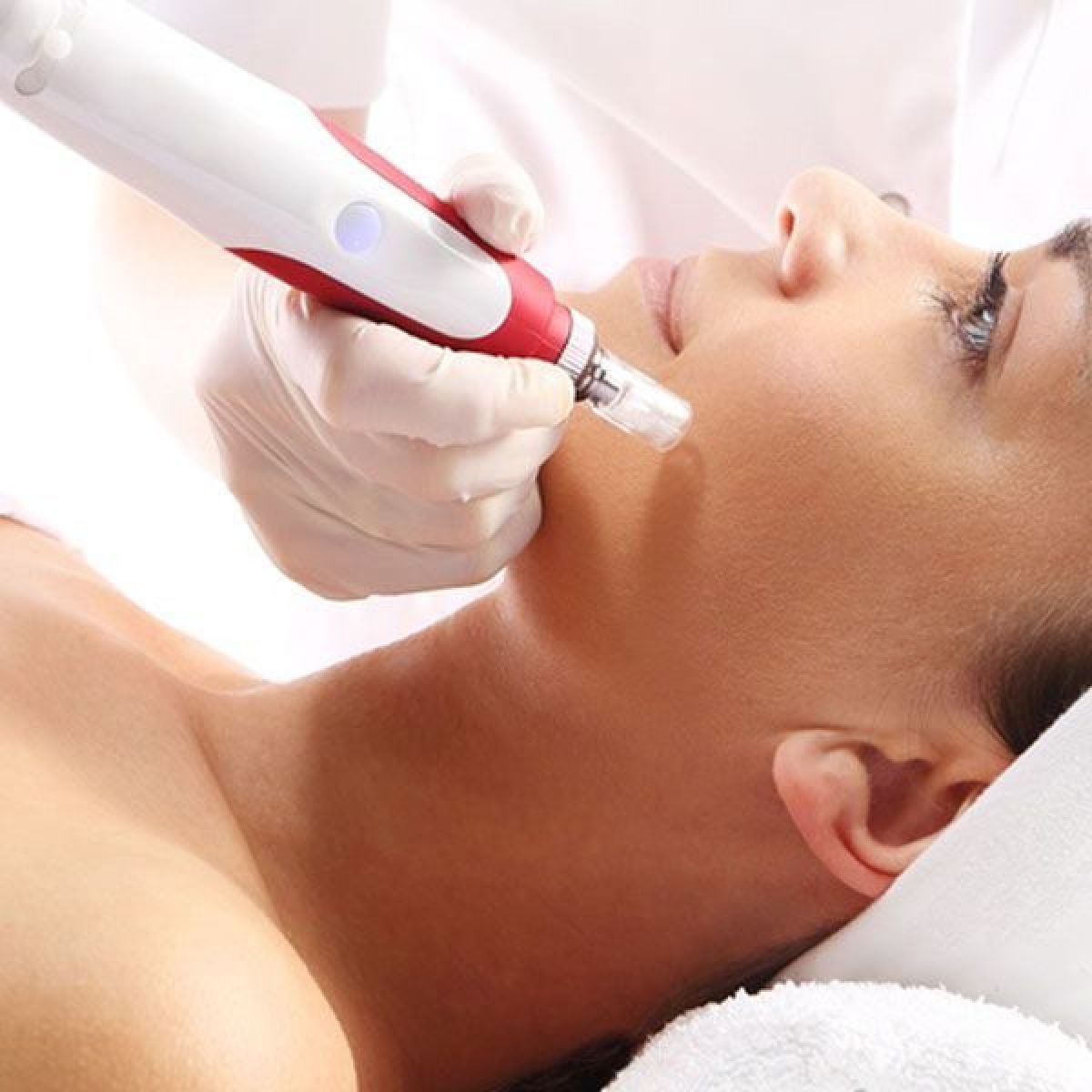 Microneedling (traces d'acné, imperfections...) à Bourg-en-Bresse (01) Par Chaimae - Estheca