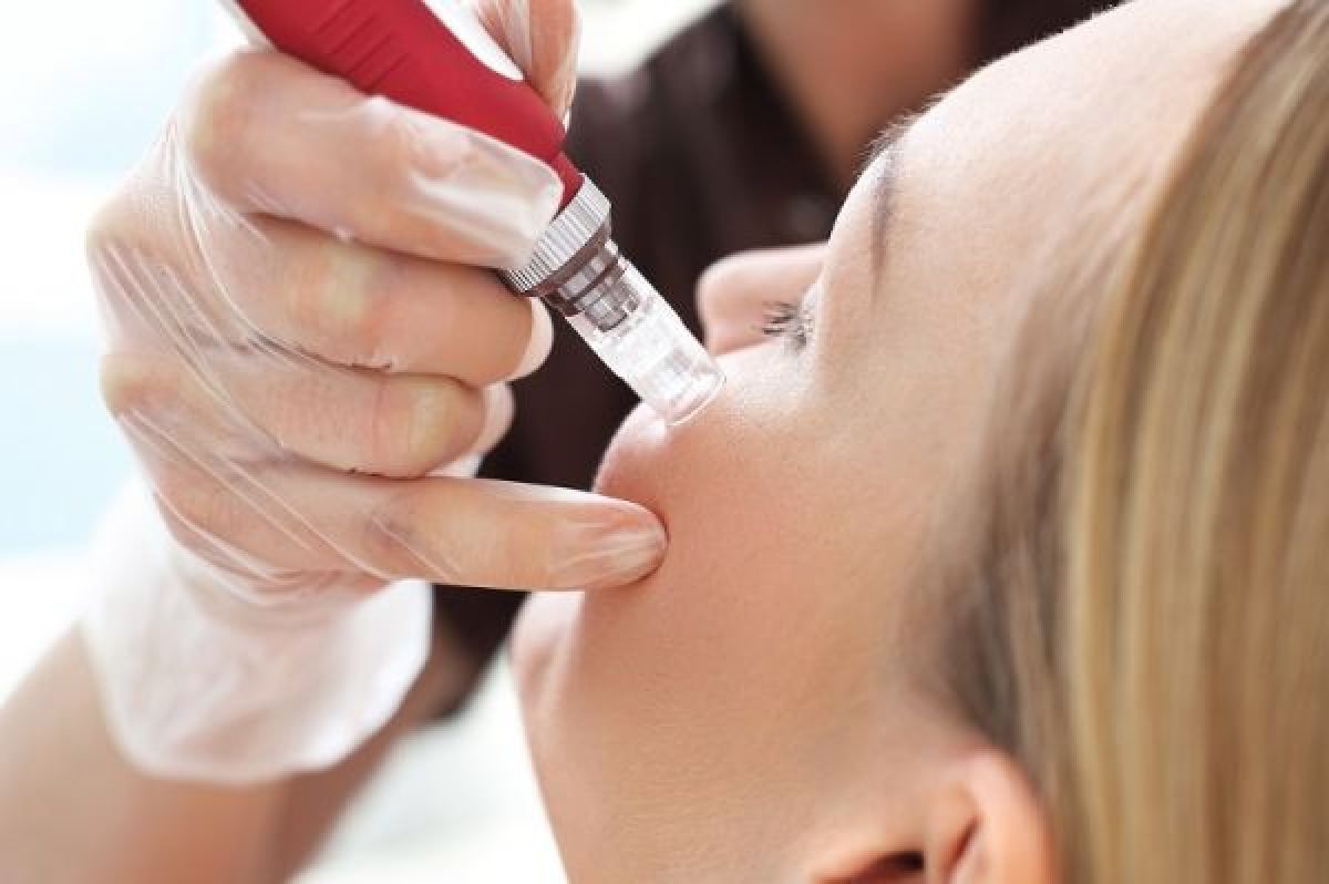 Microneedling (Acnè, tâches, rides, peaux dilatés...) à Vannes (56) Par Neijma - Estheca