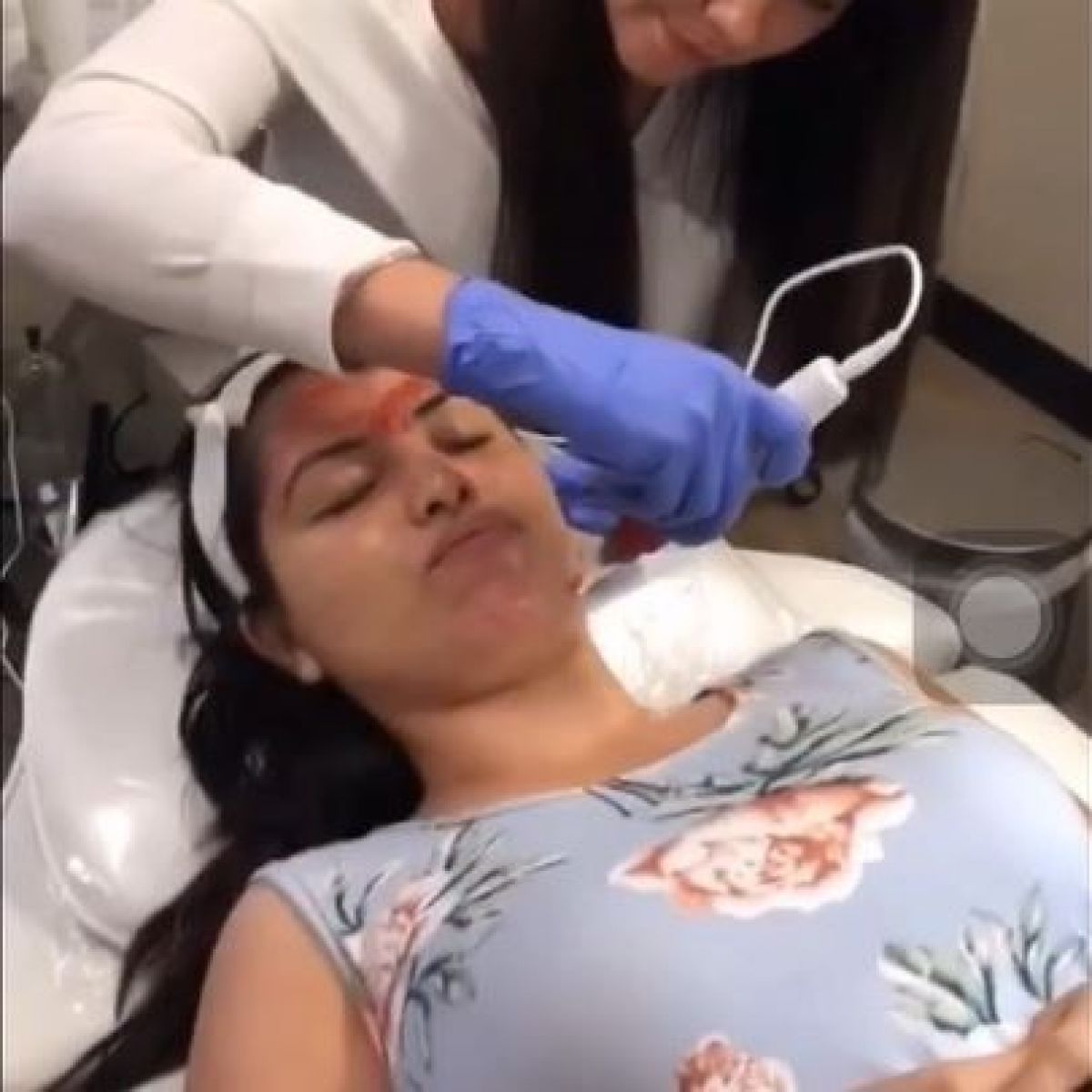 MicroNeedling BB Glow à Antony (92) Par Caroline - Estheca