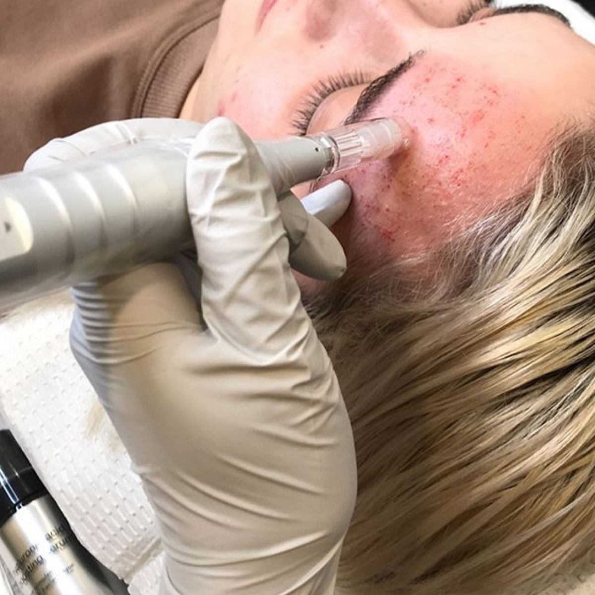 MicroNeedling BB Glow à Rezé (44) Par Mélody - Estheca