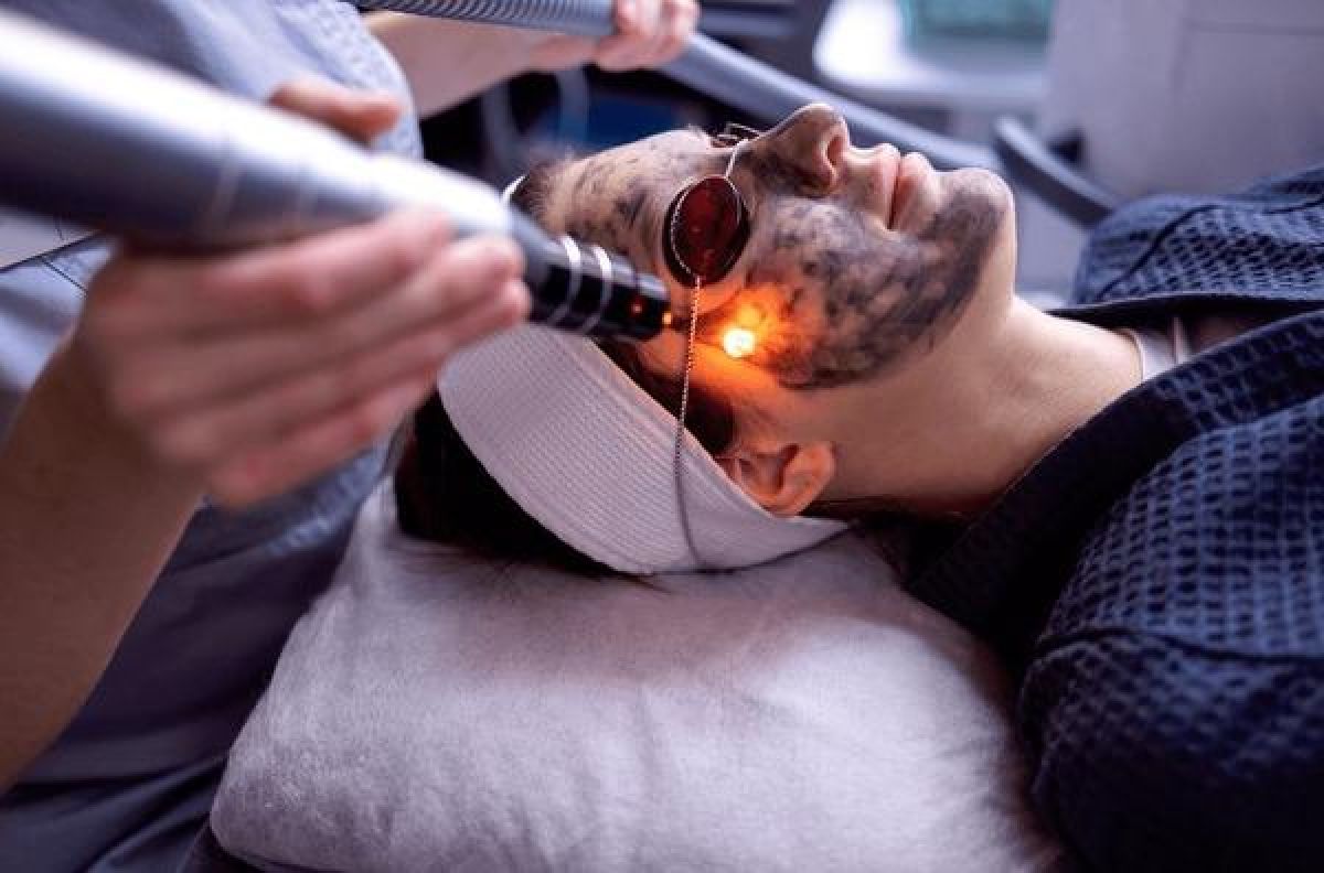 Carbone peel à Gagny (93) Par Basma - Estheca