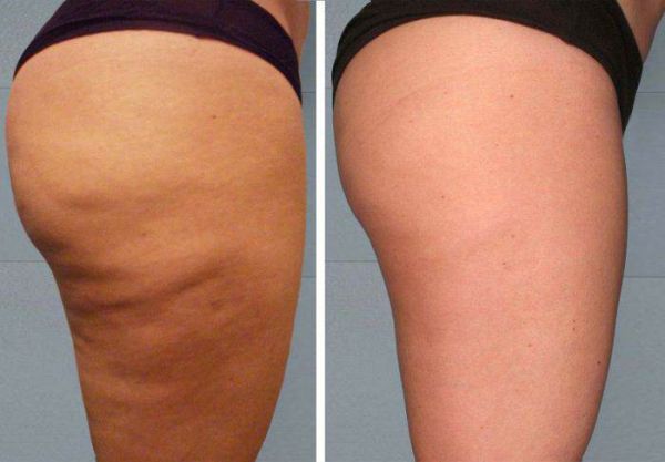 À Colmar | Lipocavitation /Radiofréquence | Les meilleures esthéticiennes