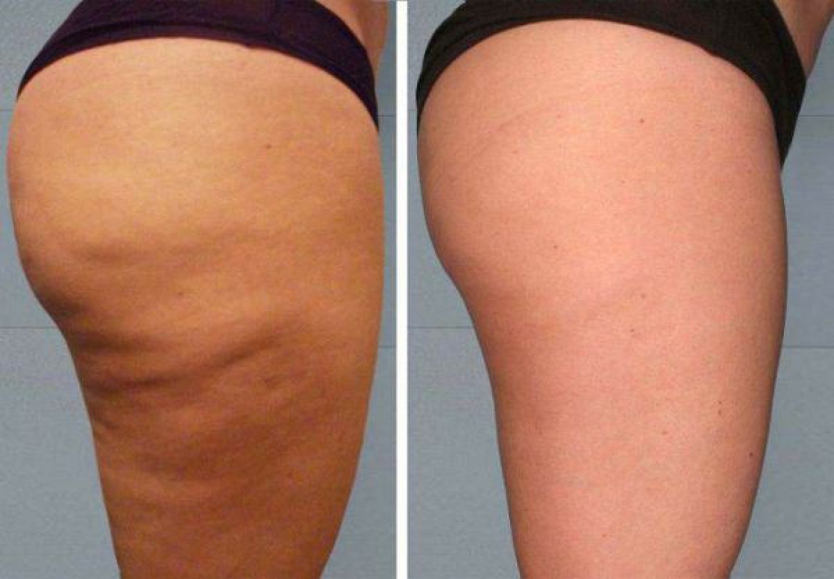 Lipocavitation / Radiofréquence  à Saint-Louis (68) Par Laëtitia - Estheca