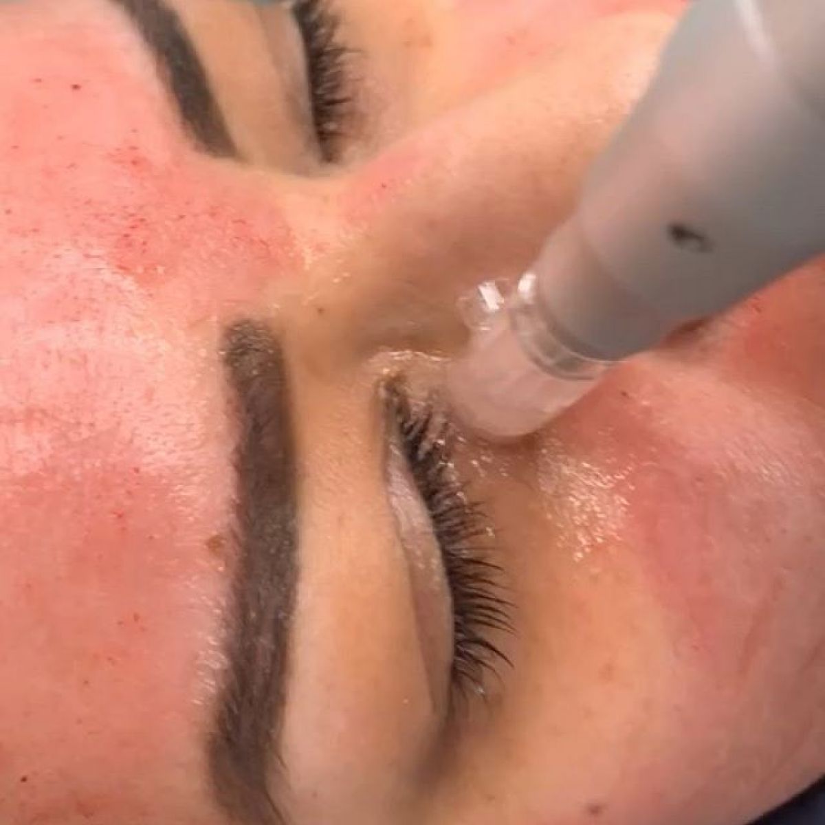 MicroNeedling BB Glow à Aubervilliers (93) Par Mélanie - Estheca