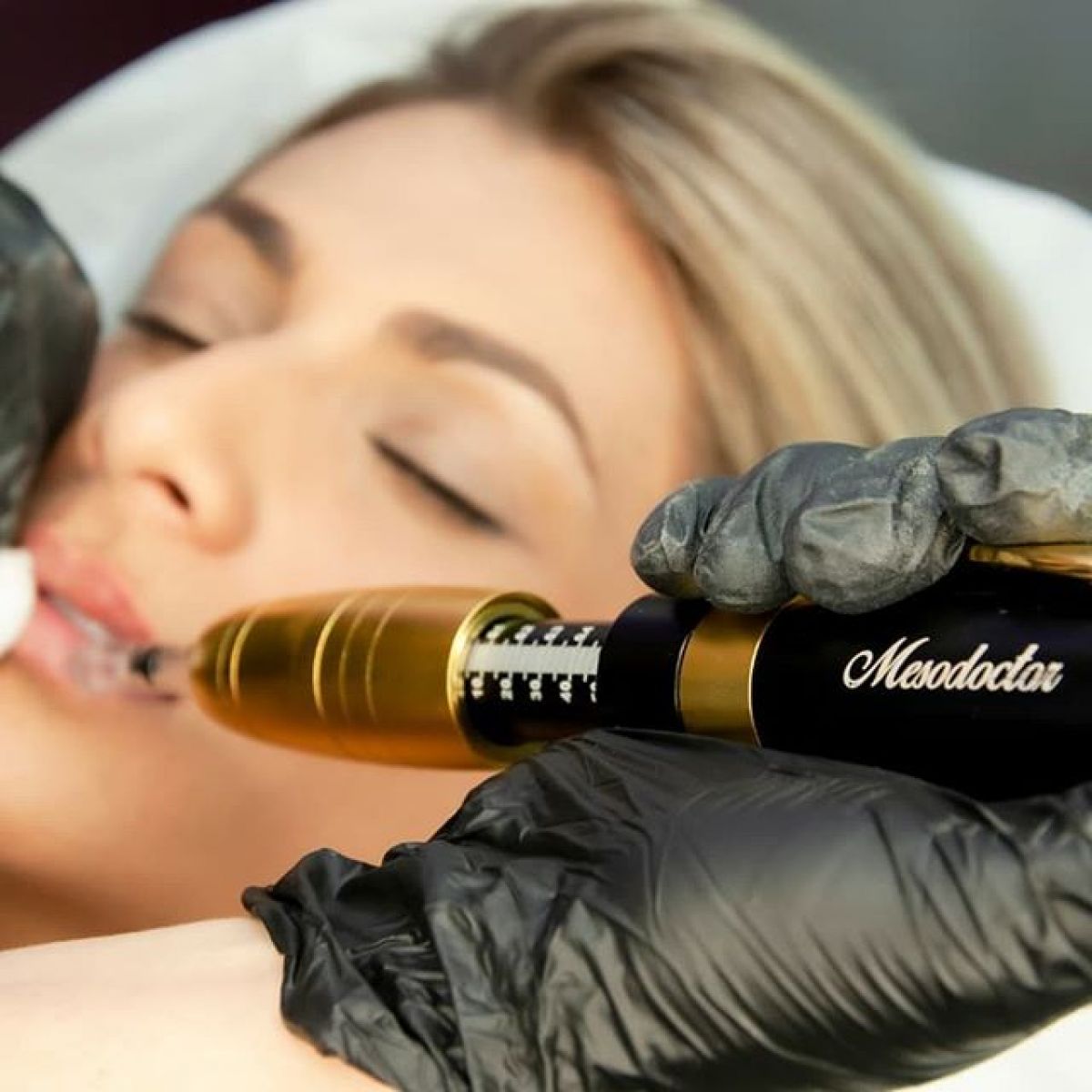 Hyaluron pen lèvres et rides à Bègles (33) Par Pauline - Estheca