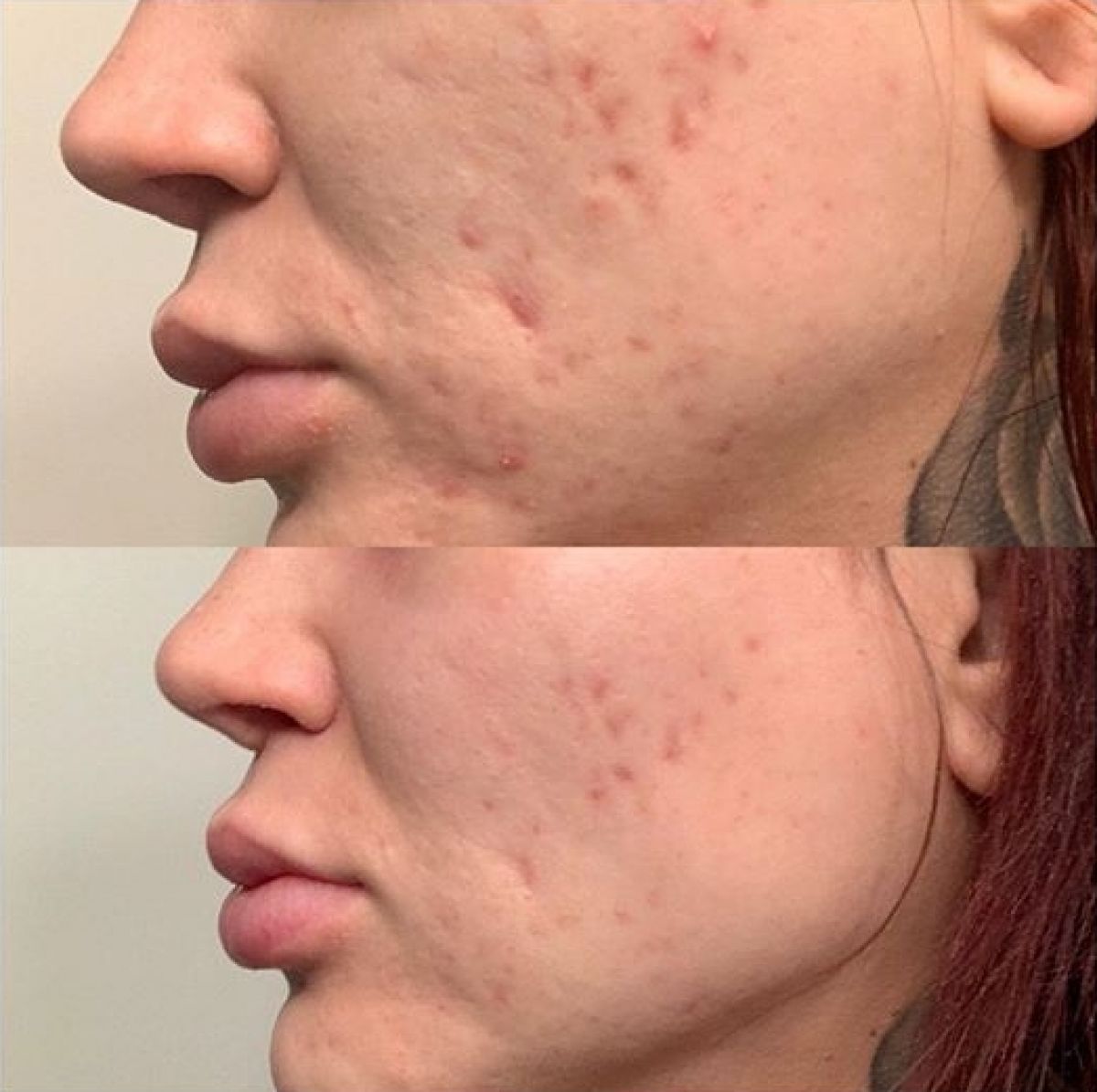 Microneedling BB GLOW à Vence (06) Par Anabelle - Estheca