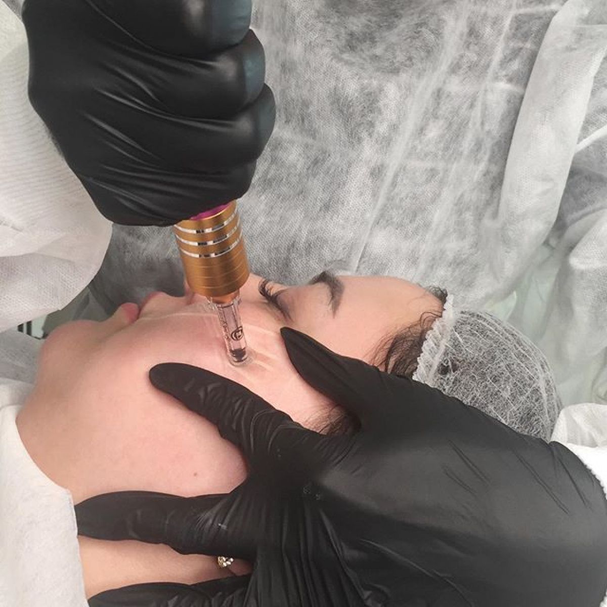 Hyaluron pen lèvres et rides à Brumath (67) Par Laure - Estheca