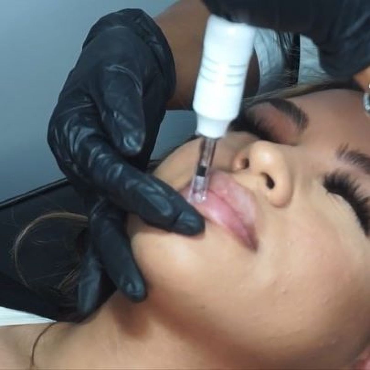 Hyaluron pen Lèvres à Bischheim (67) Par Vanessa - Estheca