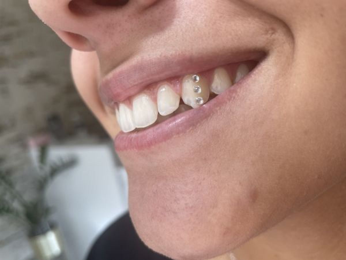 Strass dentaire à Jaunay-Clan (86) Par Vanessa - Estheca