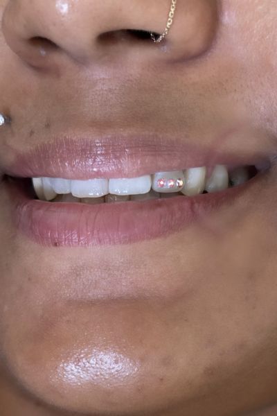 À Saint-André | Strass dentaire | Les meilleures esthéticiennes