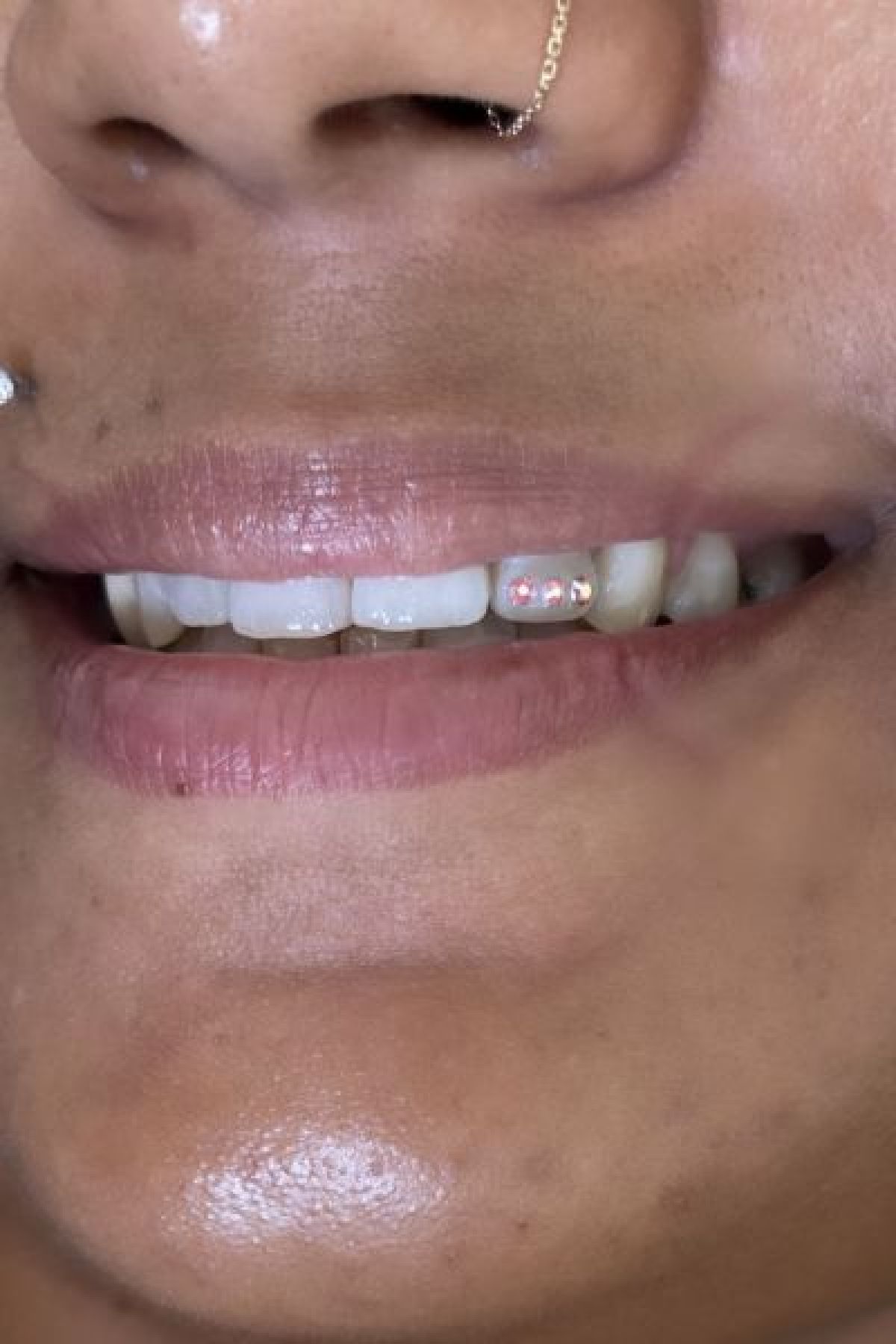 Strass dentaire à Saint-André (974) Par Anaïs - Estheca