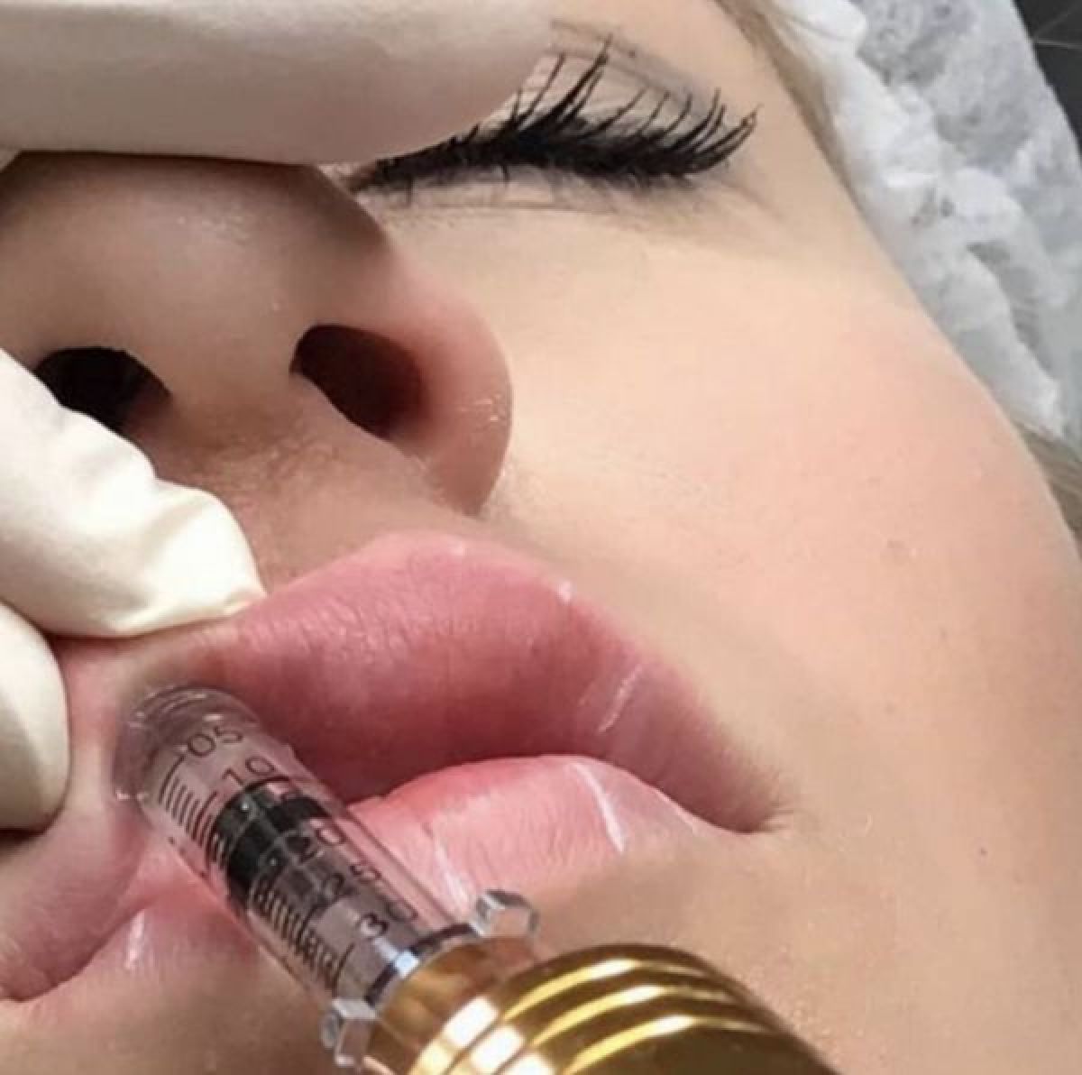 Augmentation lèvres Hyaluron pen à Cambo-les-Bains (64) Par Mélodie - Estheca