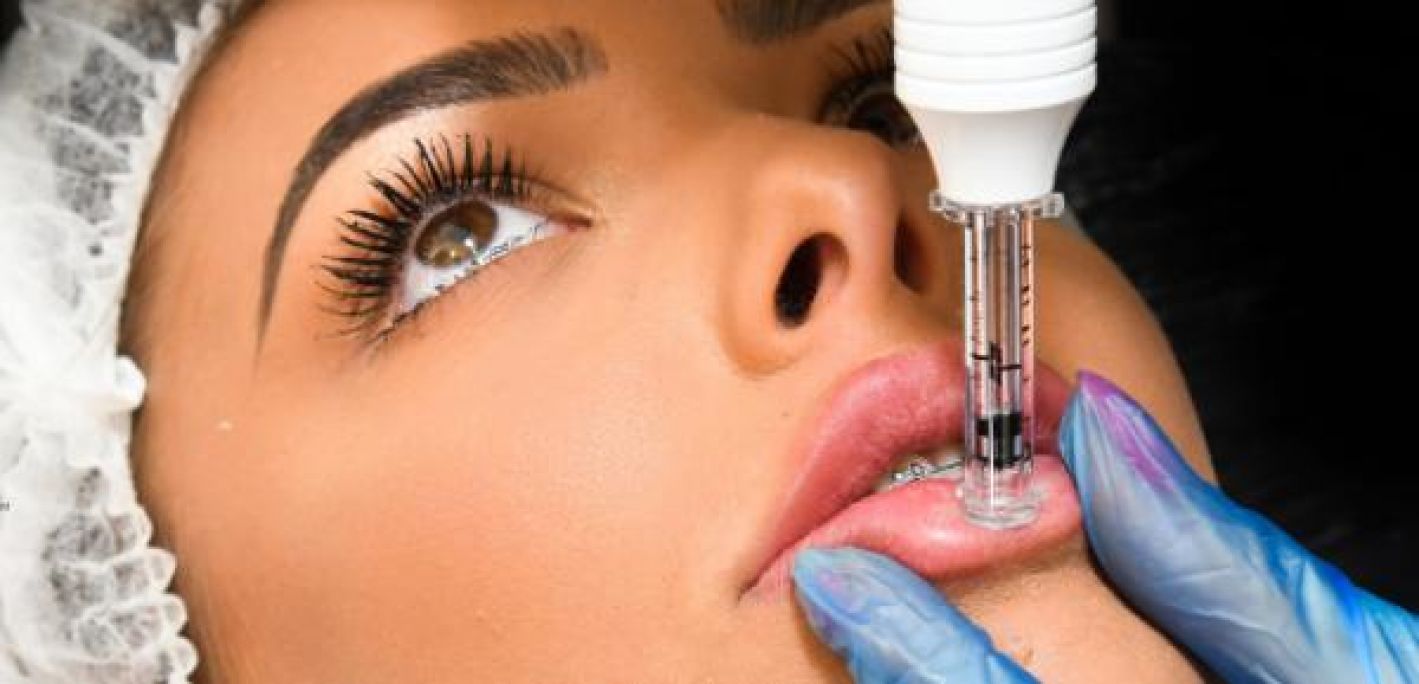 Augmentation lèvres Hyaluron pen à Anduze (30) Par Sonia - Estheca