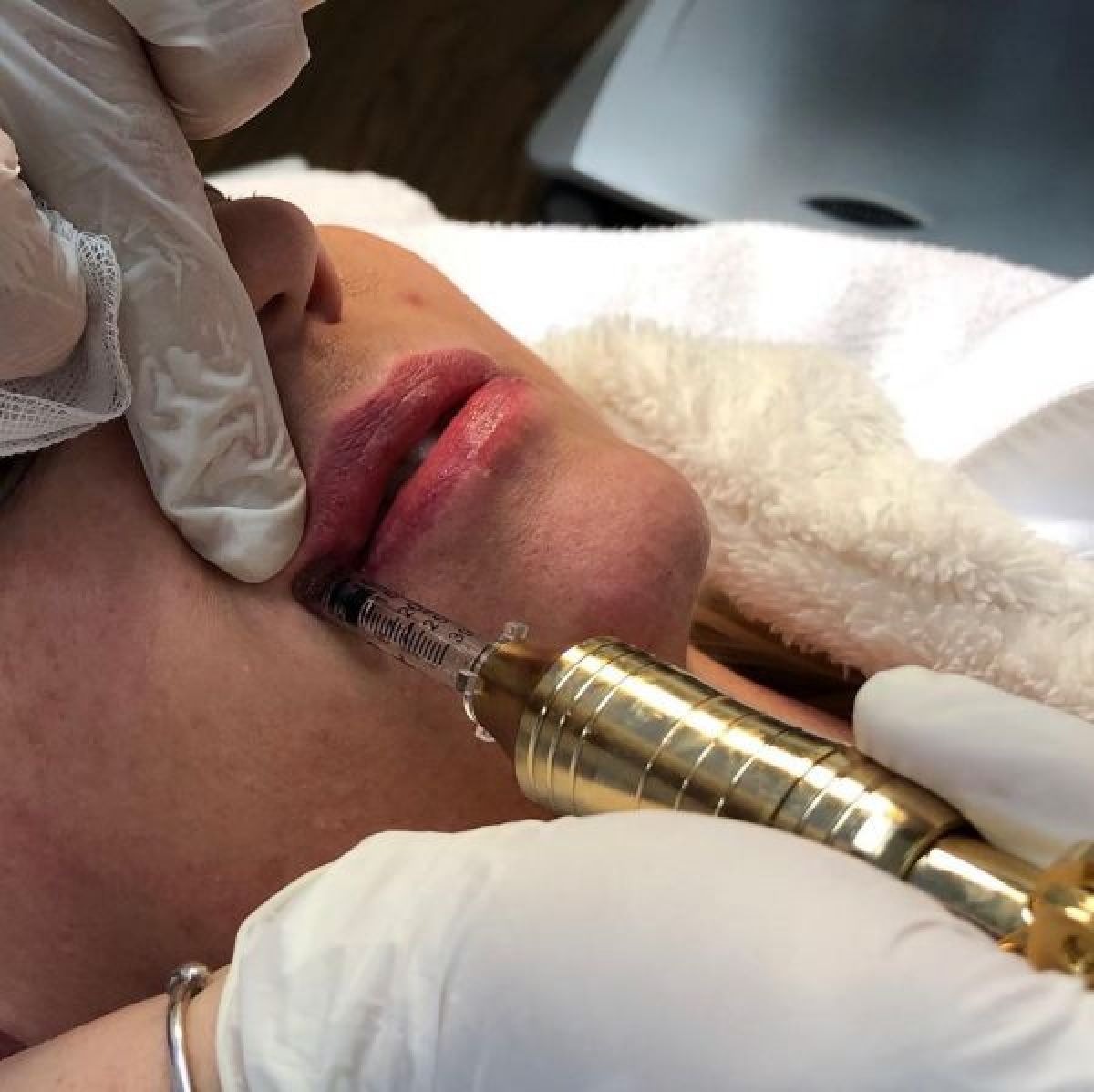 Augmentation lèvres Hyaluron pen à Ergué-Gabéric (29) Par Célia - Estheca