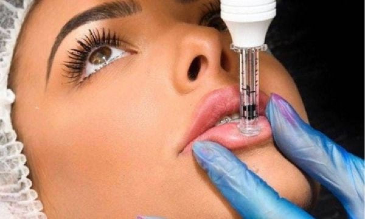Hyaluron pen Lèvres à Châteaurenard (13) Par Virginie - Estheca