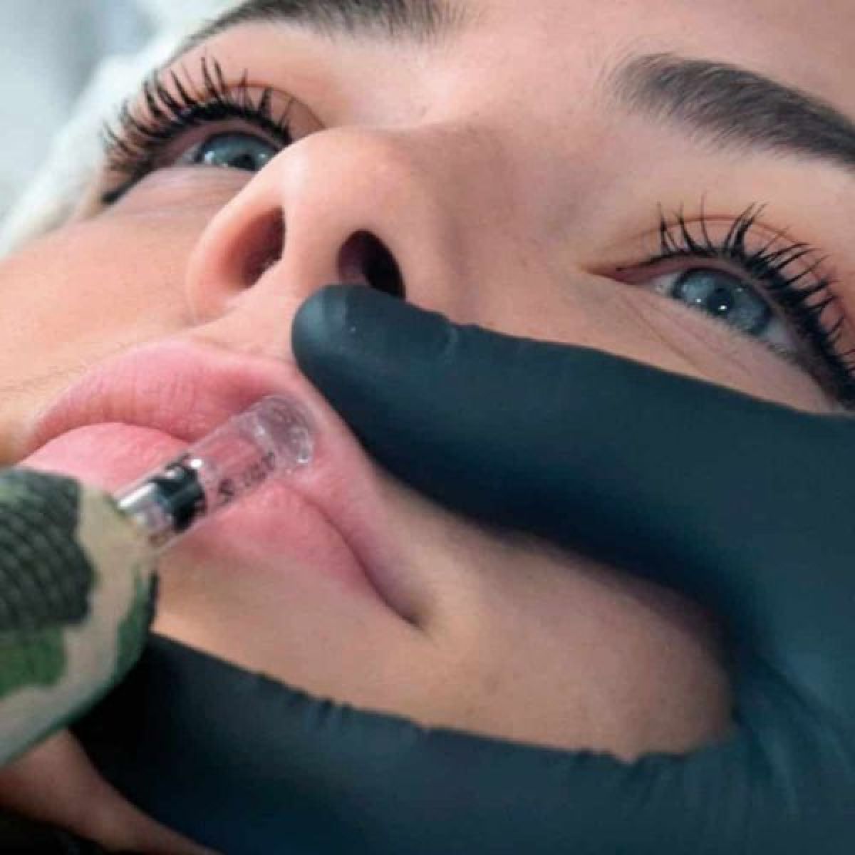 Augmentation lèvres Hyaluron pen à Saint-Germain (10) Par Angélique - Estheca