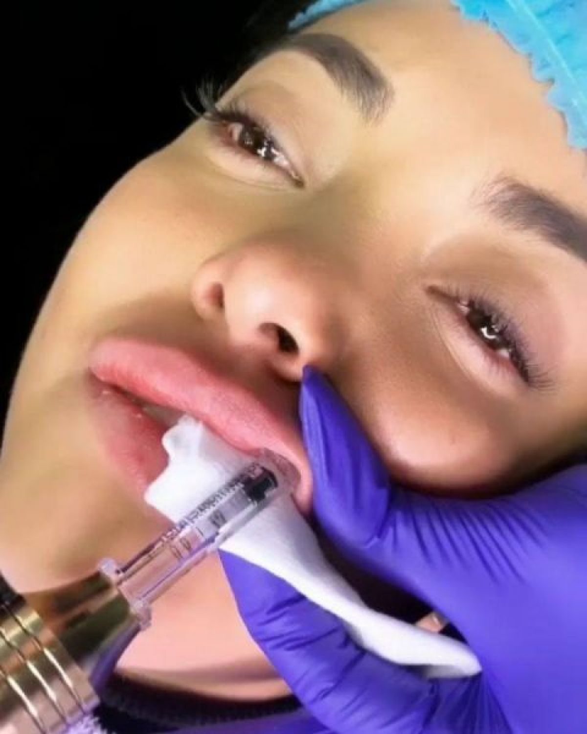 Augmentation lèvres Hyaluron pen à Vouneuil-sous-Biard (86) Par Morgane - Estheca