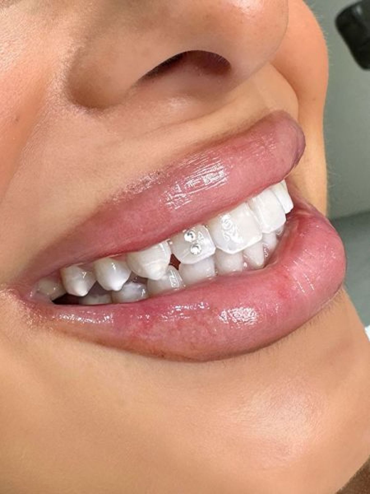 Strass dentaire à Vaulx-en-Velin (69) Par Selma - Estheca