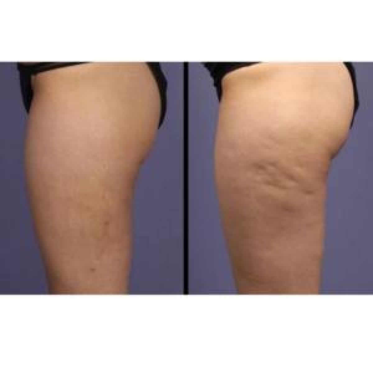 Stop cellulite et graisse à Palaiseau (91) Par Bouchra - Estheca