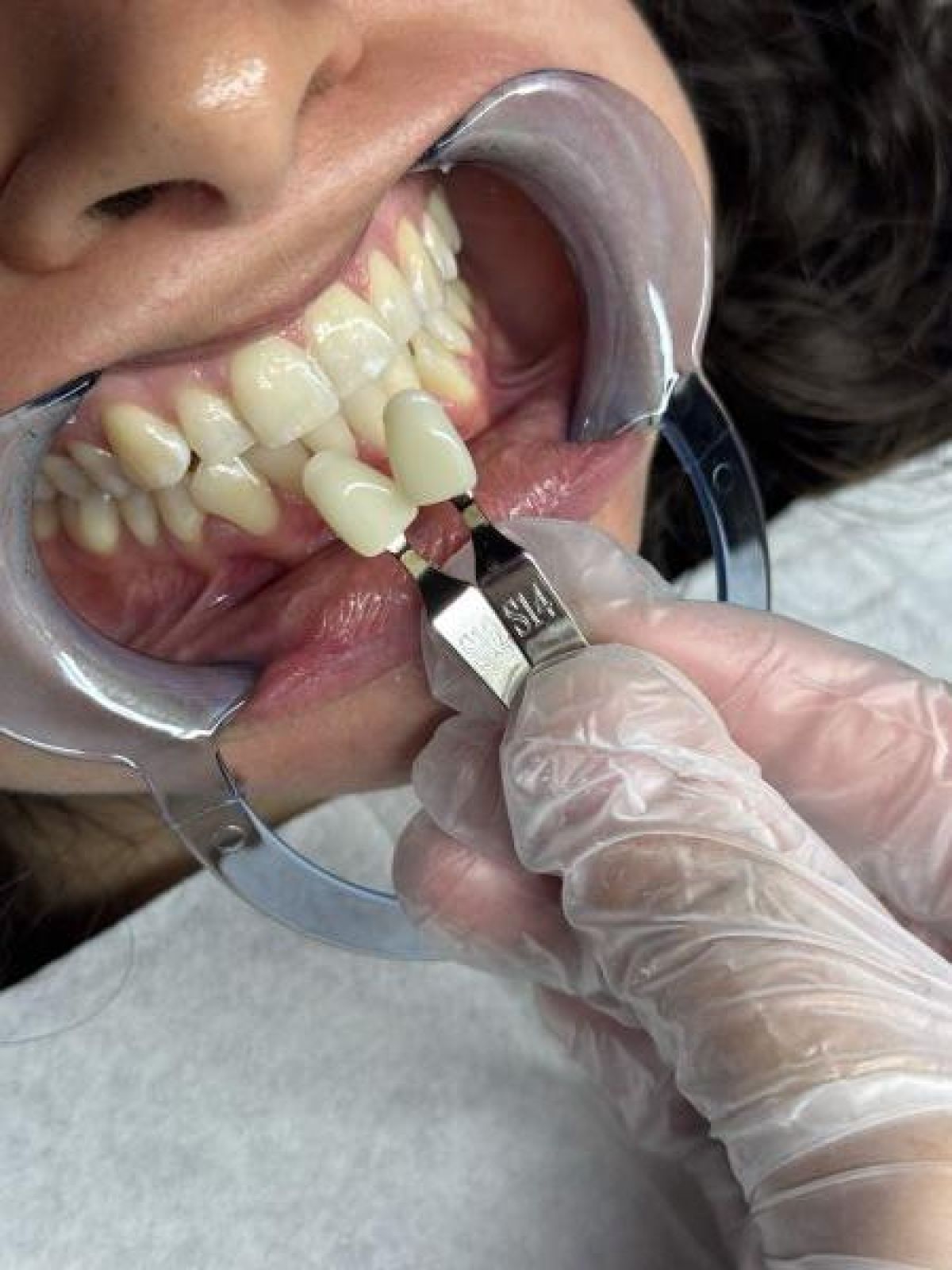 Blanchiment dentaire à Cenon (33) Par Laury - Estheca
