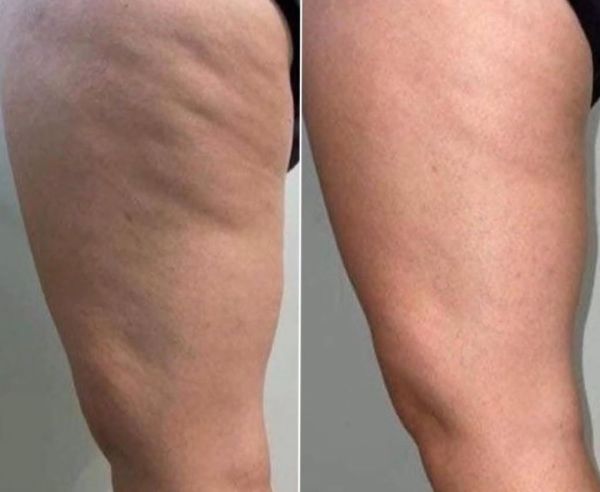 À Thionville | Soins Anti-Cellulite & Remodelage Corporel | Les meilleures esthéticiennes