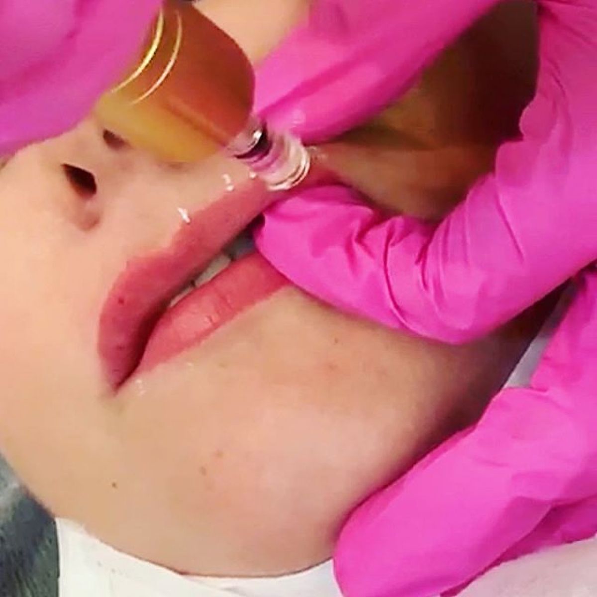 Augmentation des lèvres Hyaluron pen à Nanterre (92) Par Émilie - Estheca