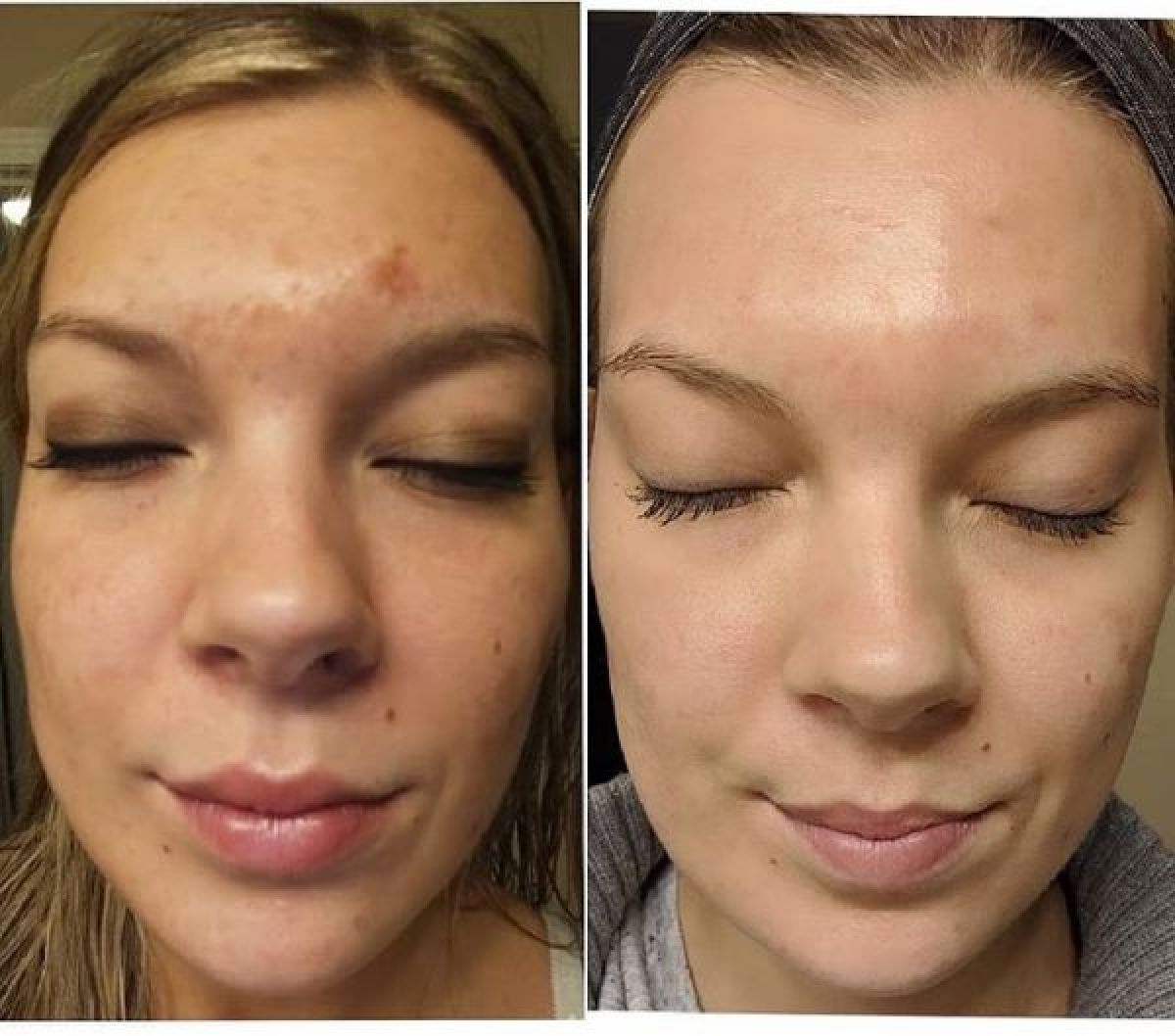 Microneedling à Mons-en-Baroeul (59) Par Angelique - Estheca