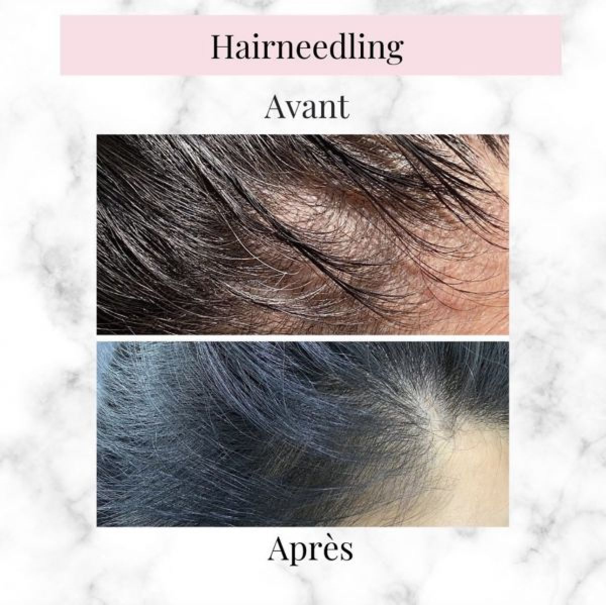 Hair needling à Grenoble (38) Par Dounia - Estheca