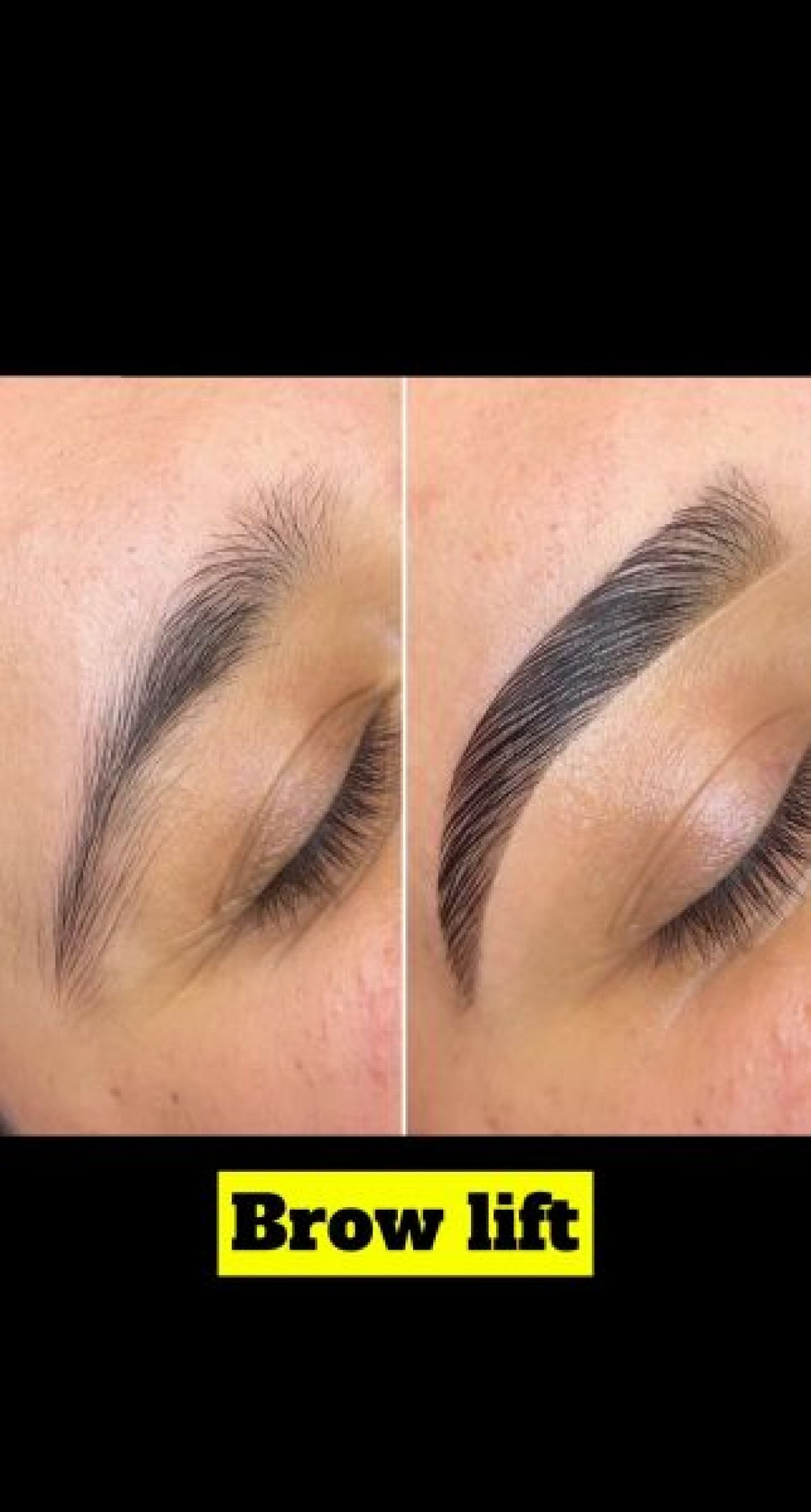 Brow lift à Montbéliard (25) Par Anissa - Estheca