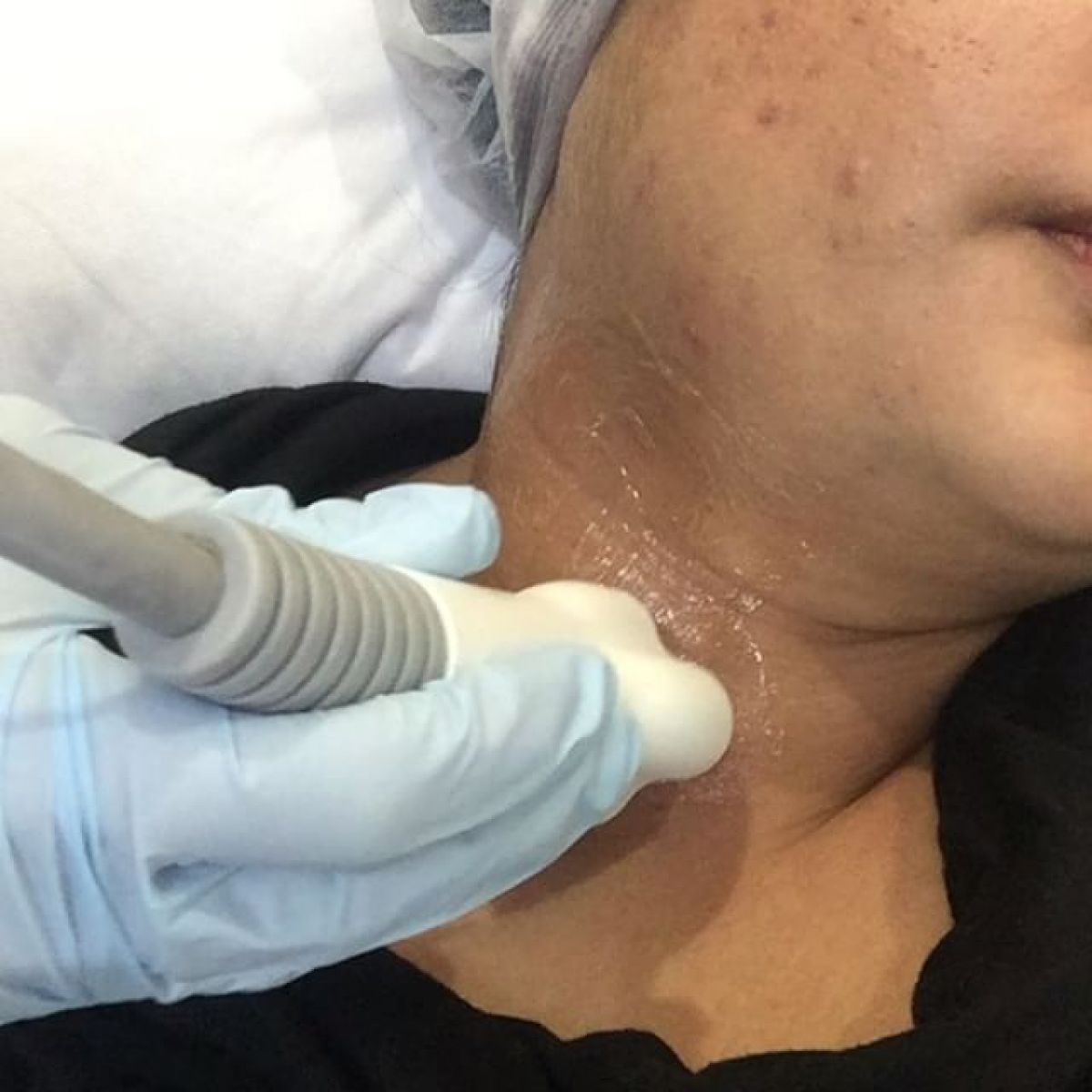 Radio fréquence / Lipocavitation à Lingolsheim (67) Par Camille - Estheca