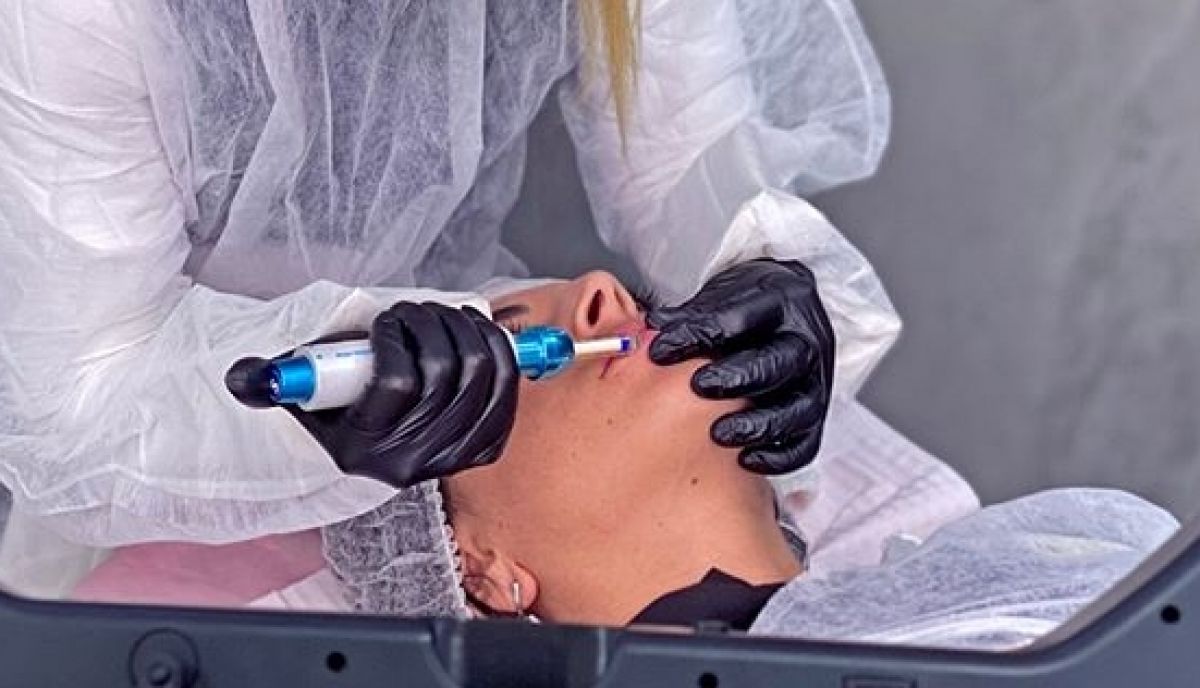 Augmentation lèvres Hyaluron pen à Franconville (95) Par Morgane - Estheca