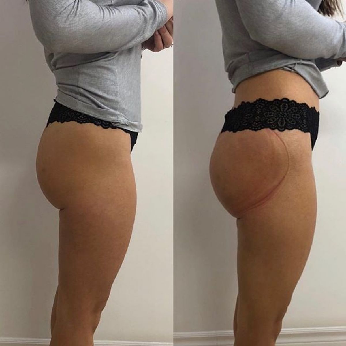Lifting Colombien à Antibes (06) Par Samantha - Estheca