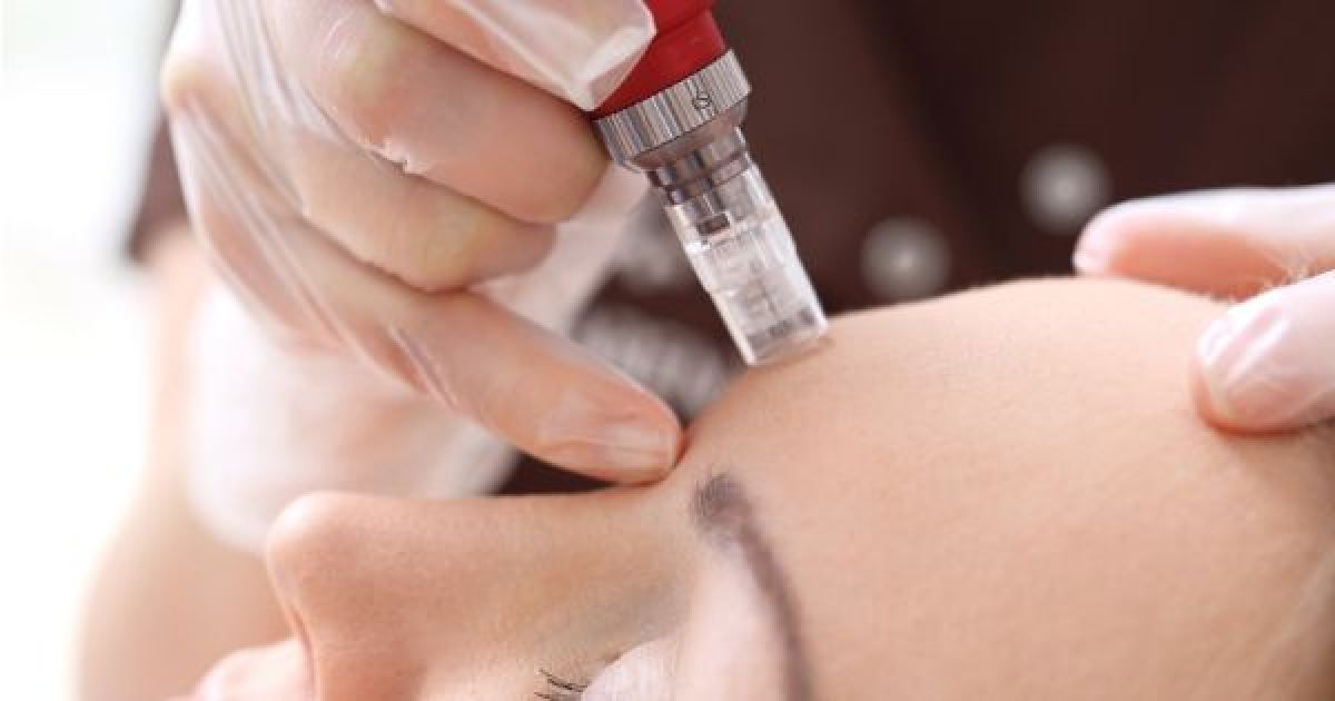 Microneedling / BB GLOW à Paris (75) Par Samya - Estheca