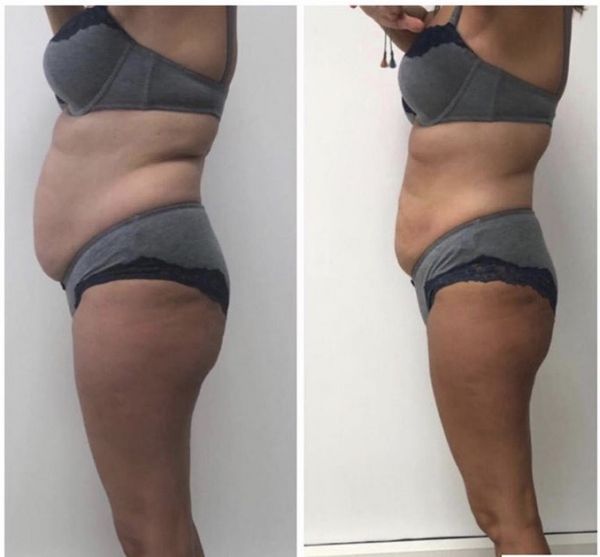 À Brie-Comte-Robert | Lipocavitation  (amincissement )rasping  | Les meilleures esthéticiennes