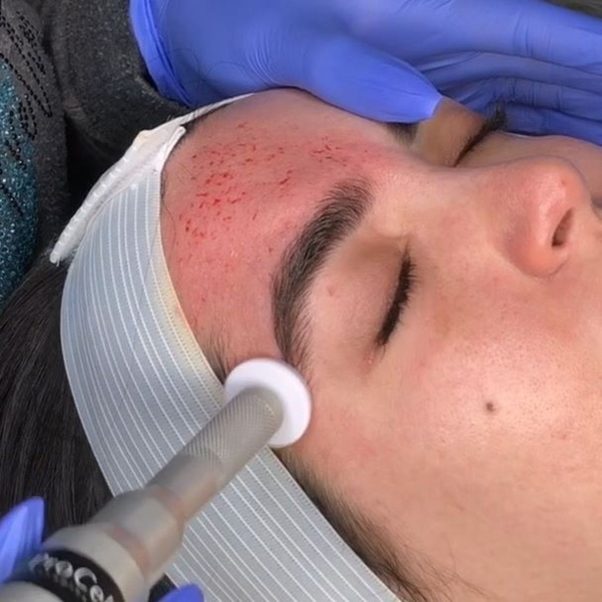 MicroNeedling BB Glow à Massy (91) Par Chloé - Estheca