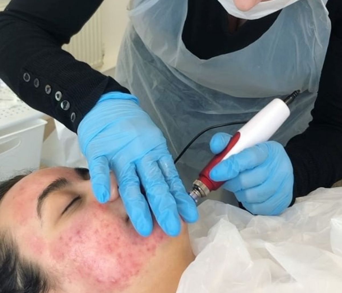 MicroNeedling BB Glow à Solliès-Pont (83) Par Morgane - Estheca