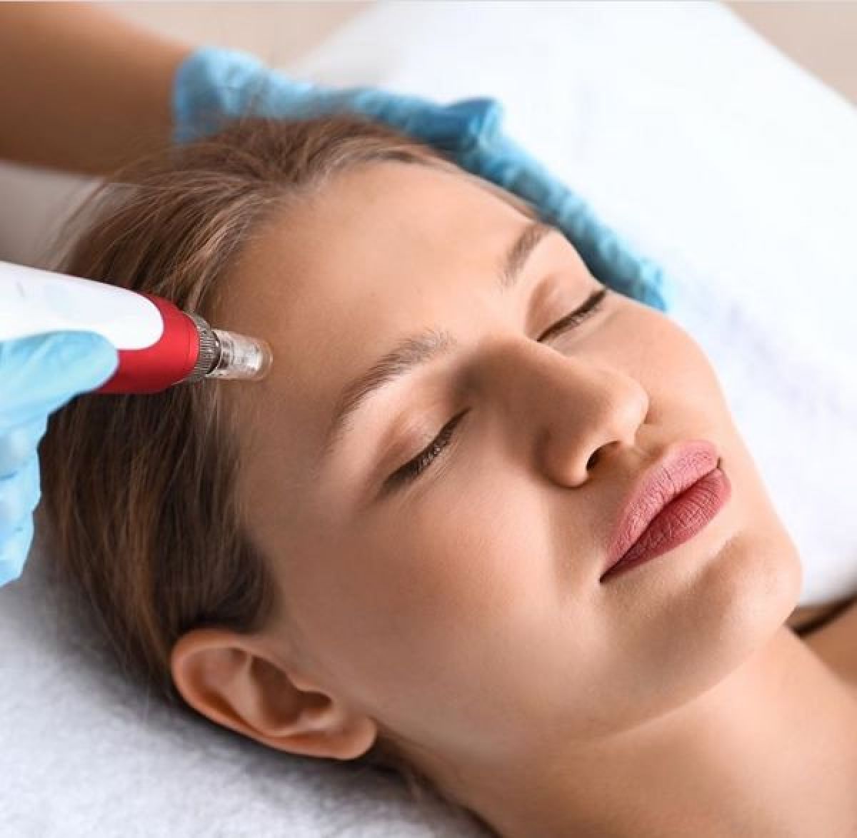 Microneedling BB GLOW à Rennes (35) Par Léa - Estheca