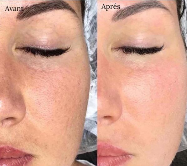 À Saint-Ouen | Microneedling BB GLOW | Les meilleures esthéticiennes