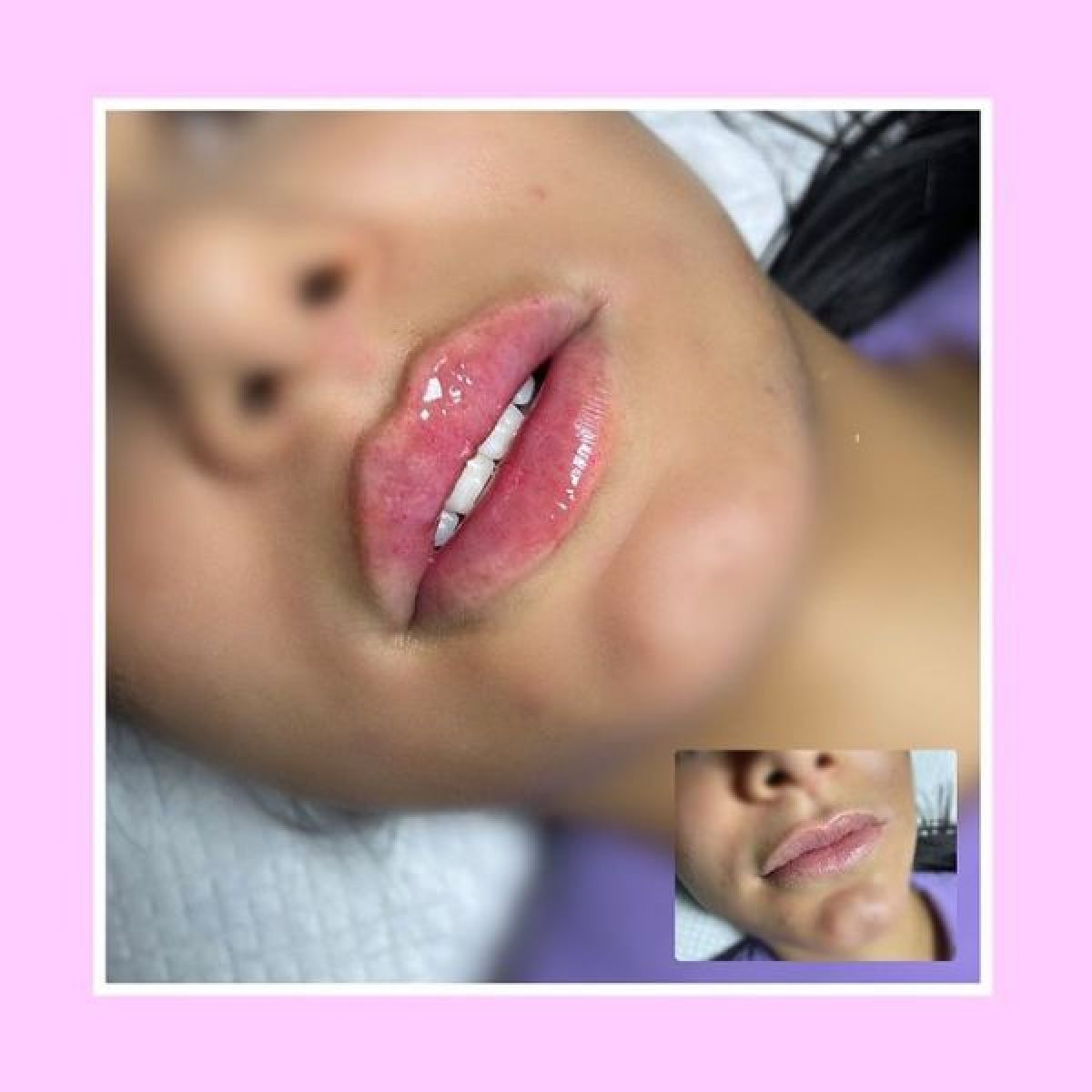 Injections acide hyaluronique (russian lips, sillons...) à Le Rove (13) Par Alissa - Estheca