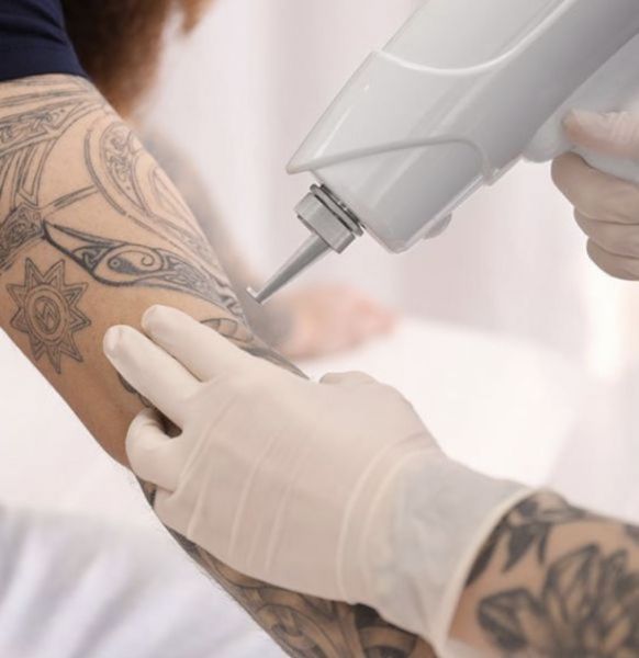 À Montgeron | Détatouage laser | Les meilleures esthéticiennes