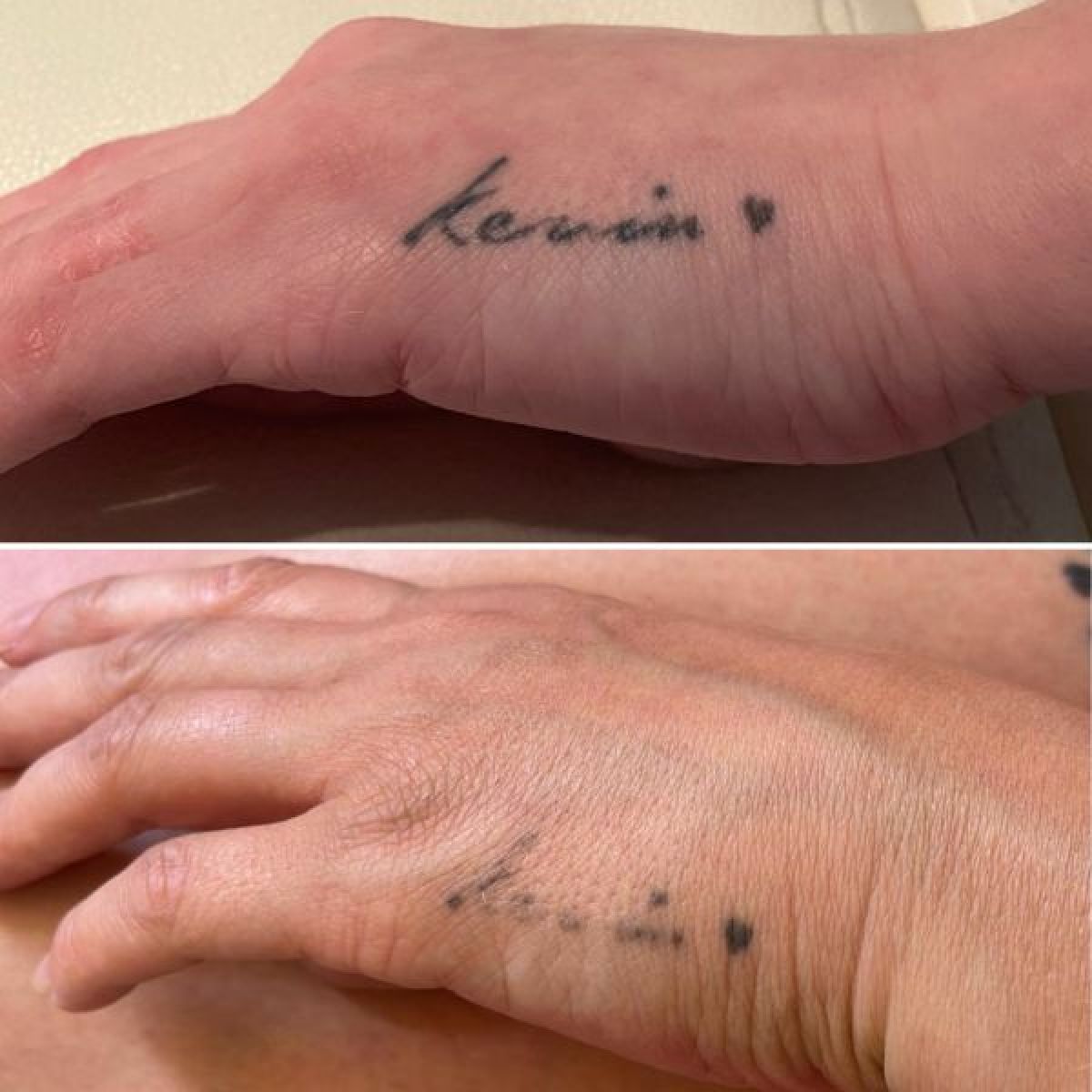 Détatouage à Reims (51) Par Gayane - Estheca