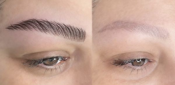 À Mulhouse | Détatouage | Les meilleures esthéticiennes