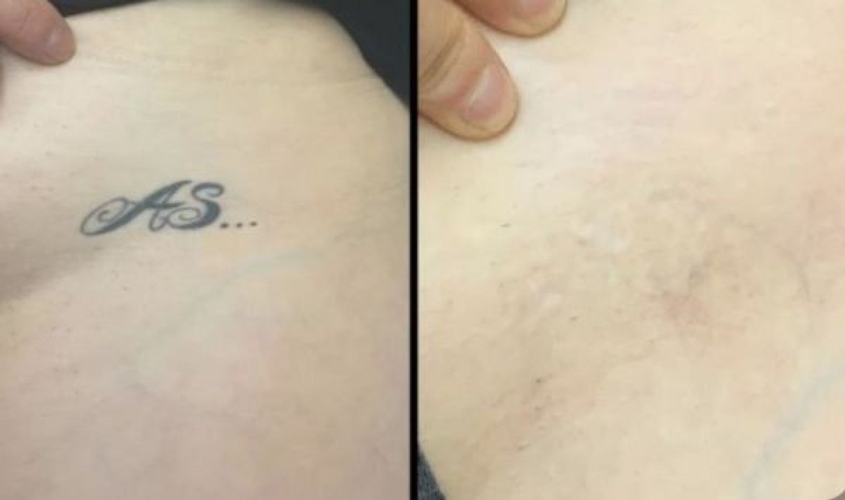 Détatouage Laser Pico à Guénange (57) Par Magalie - Estheca