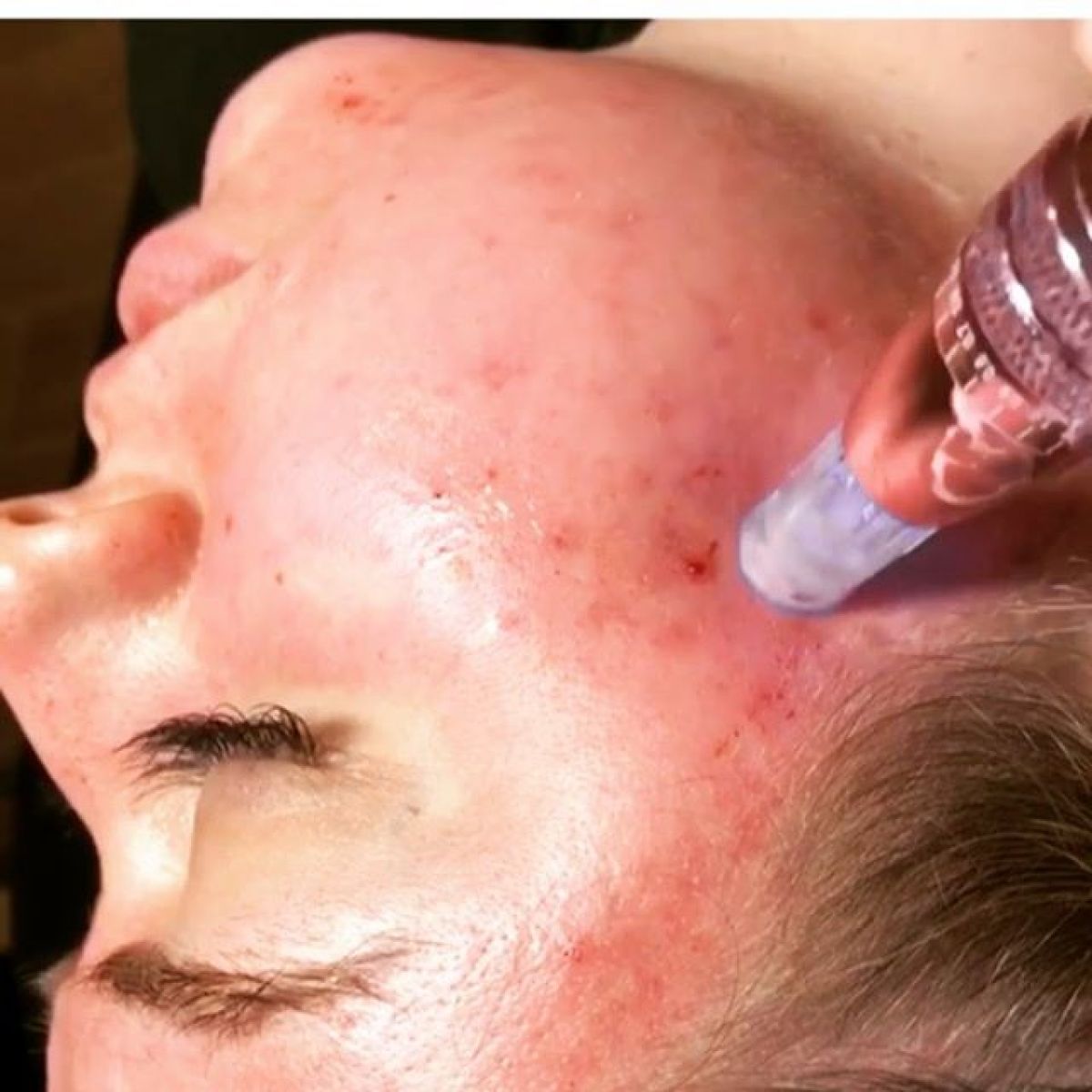 MicroNeedling BB Glow à Nancy (54) Par Audrey - Estheca