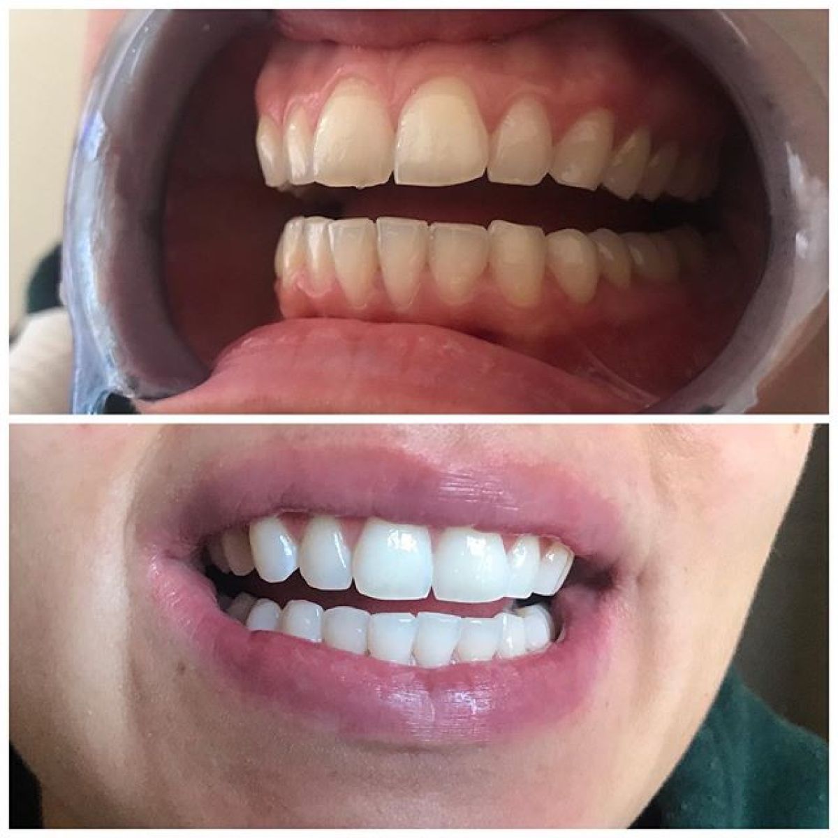 Blanchiment dentaire à Biot (06) Par Charlotte - Estheca