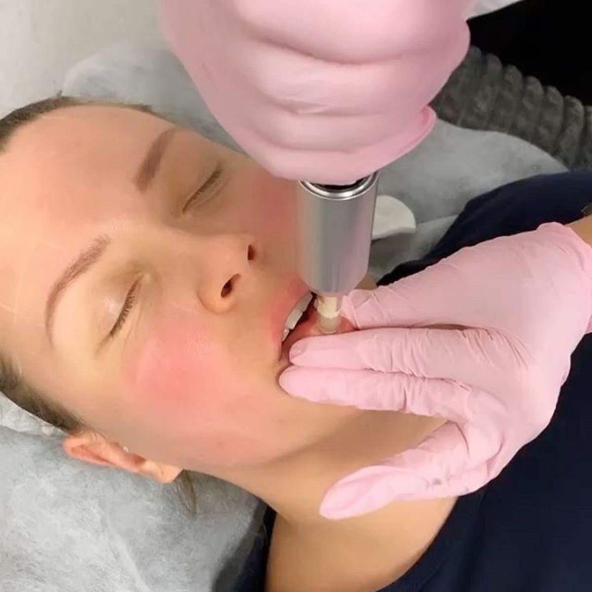 Hyaluron pen Lèvres à Dax (40) Par Mélanie - Estheca