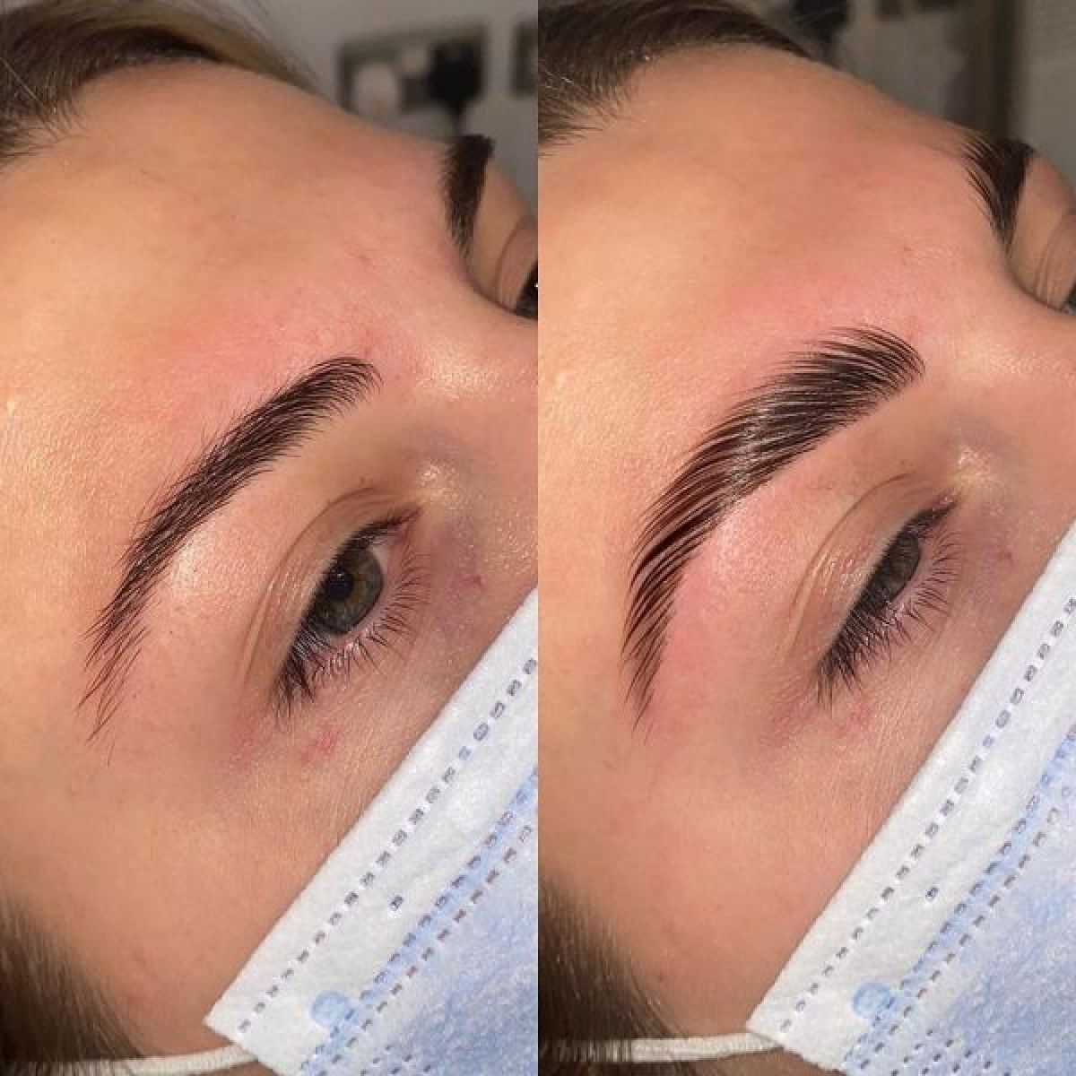 Brow lift à Saint-Maixent-l'École (79) Par Rhizlene - Estheca