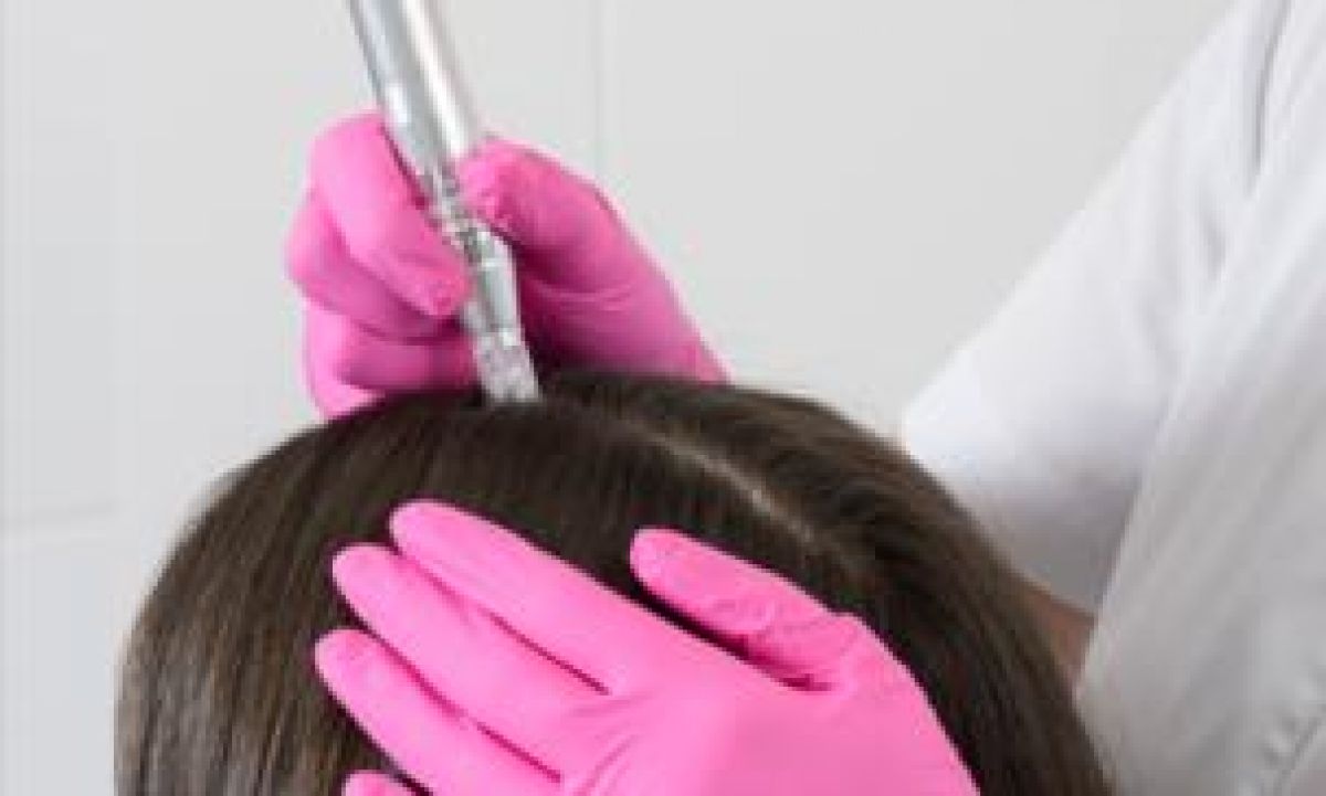 Hairneedling contre les chutes de cheveux à Valence (26) Par Rozimeire - Estheca