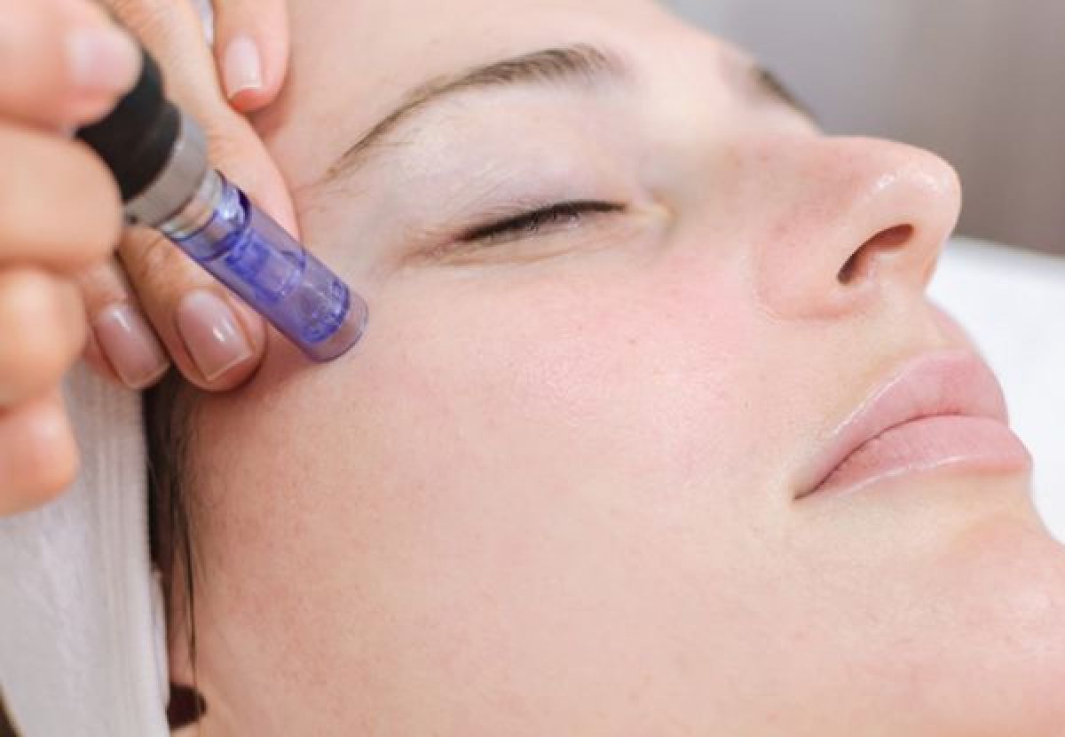 Microneedling à Villabé (91) Par Kams - Estheca