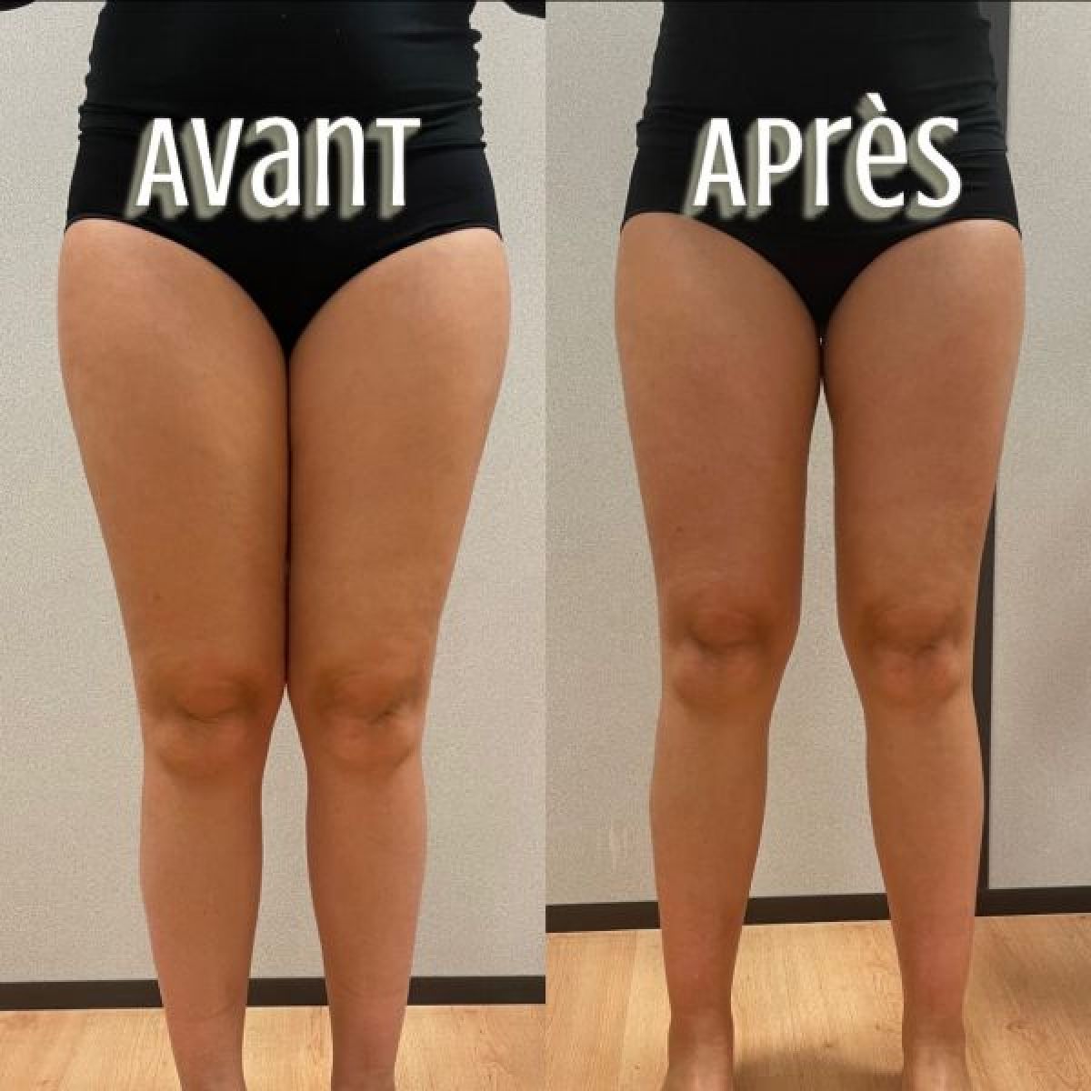 Cryo jambes légères à Nice (06) Par Marie - Estheca